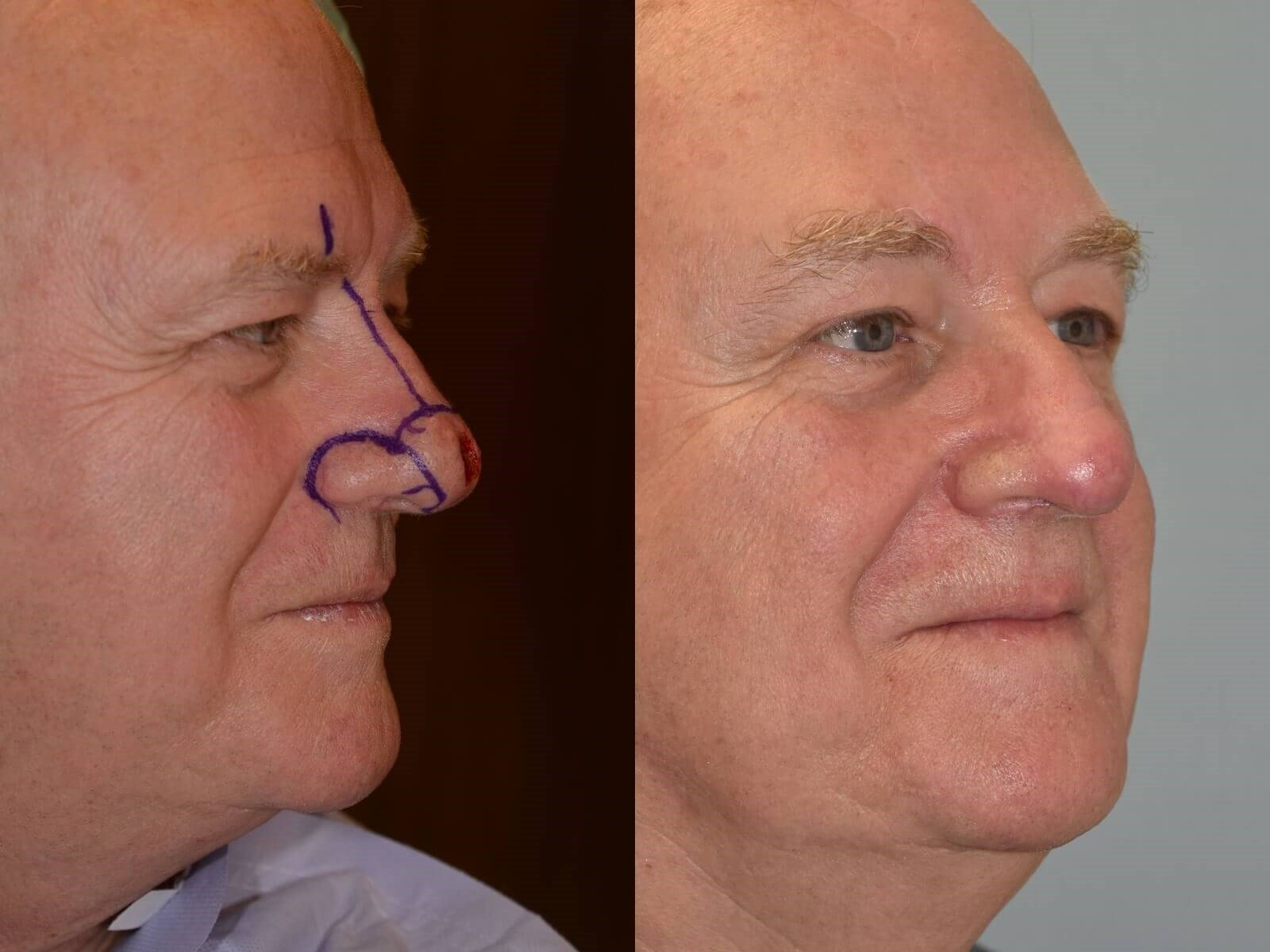 paramedian forehead flap before and after