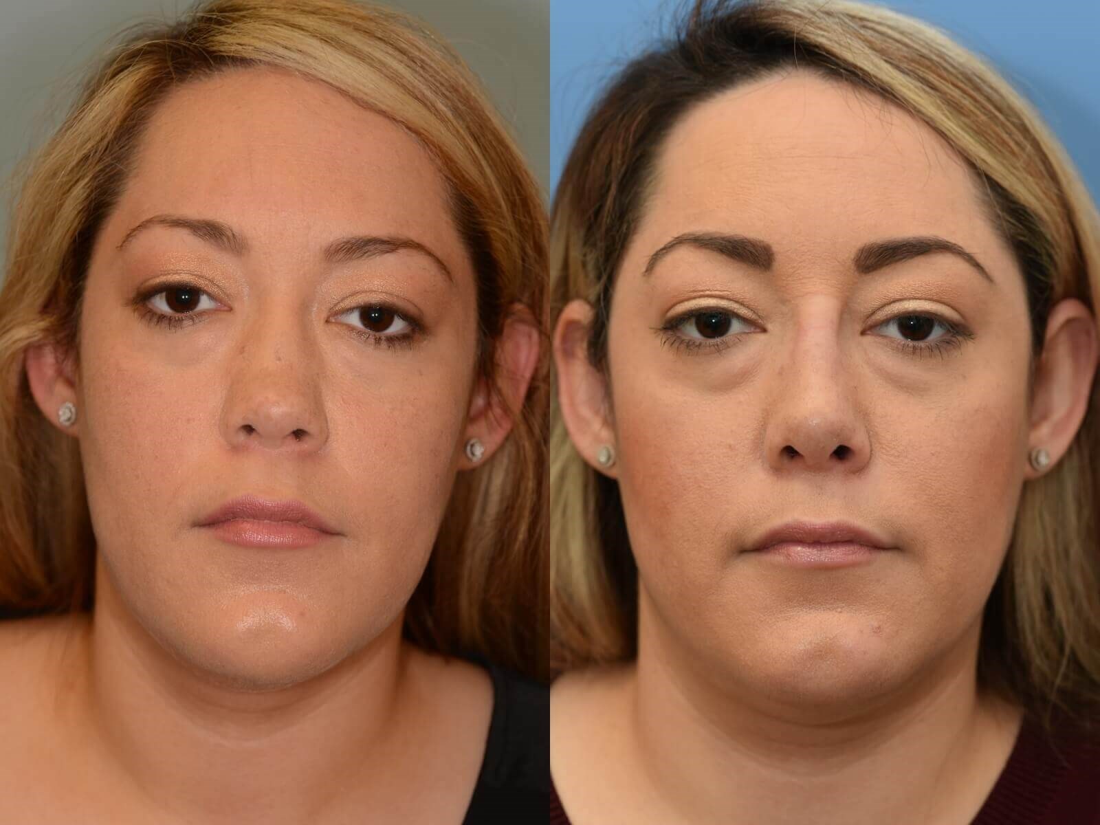 Nasal Valve Repair to Breathe! Before and After