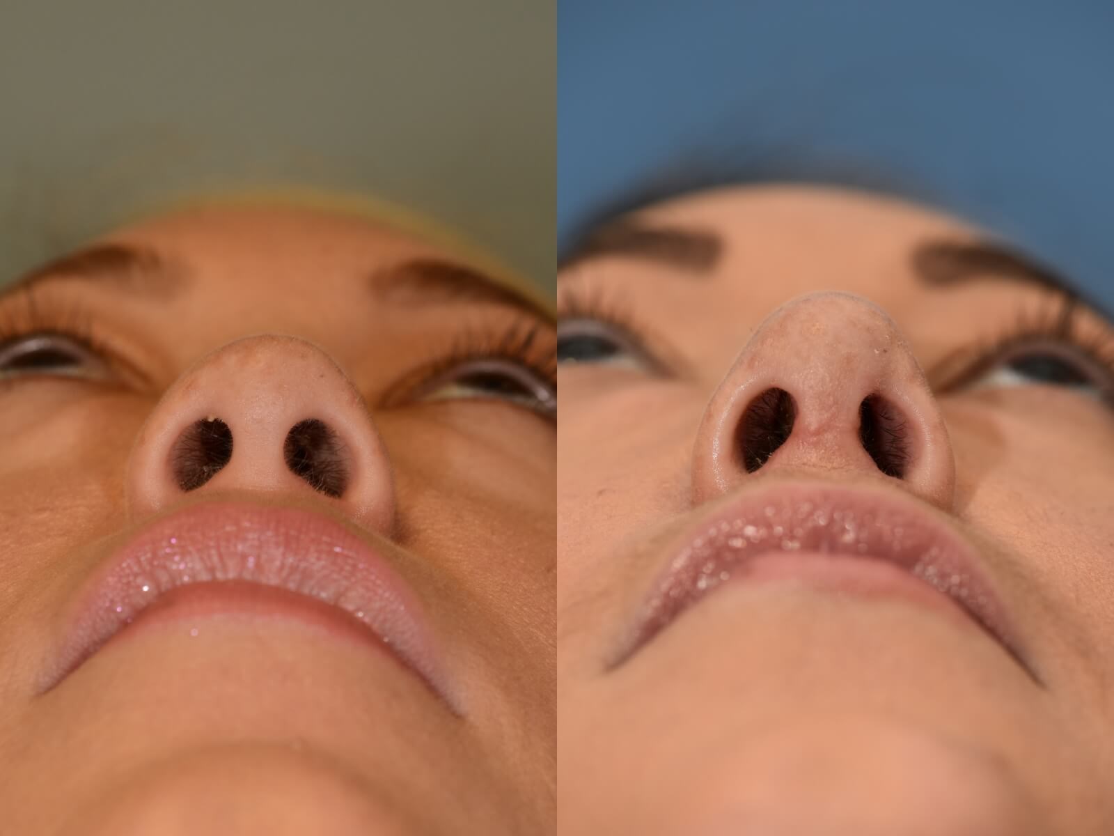 Nasal Valve Repair to Breathe! Before and After