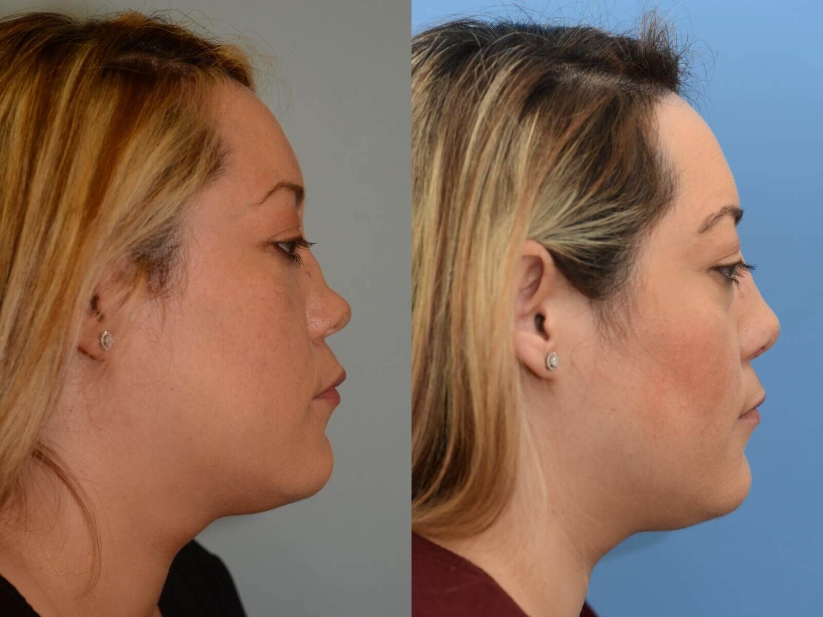 Restored profile Before and After