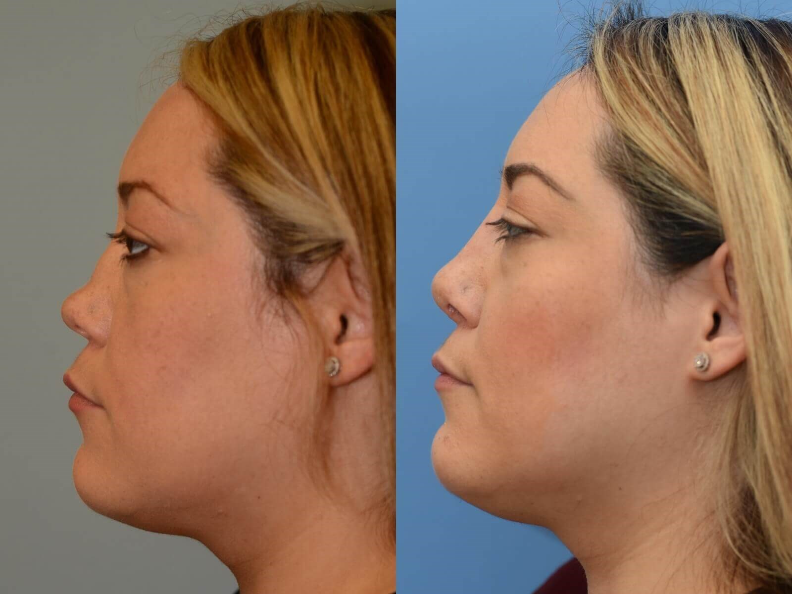 Restored profile Before and After