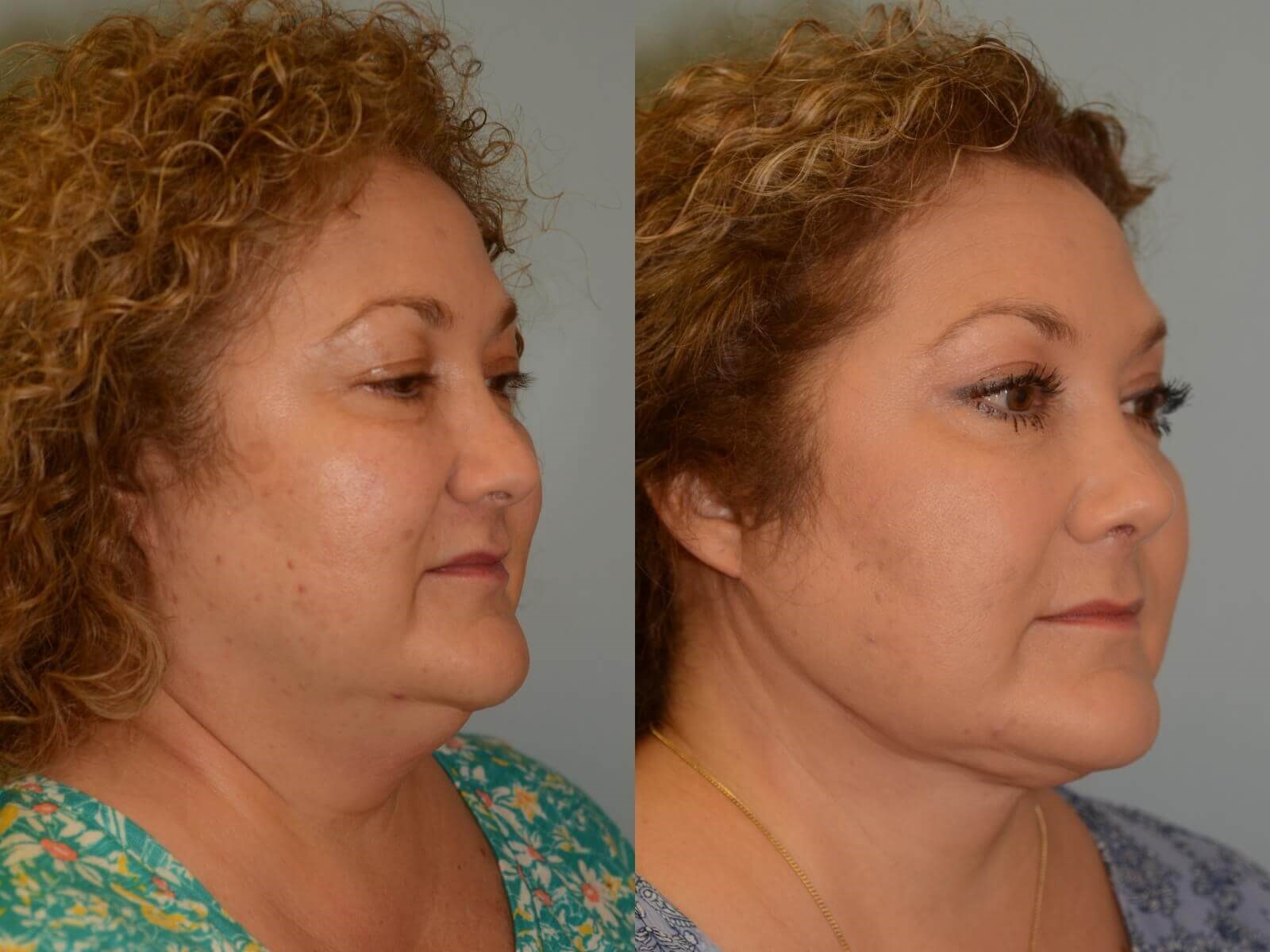 Before and After Neck Lift & Chin Liposuction Photos
