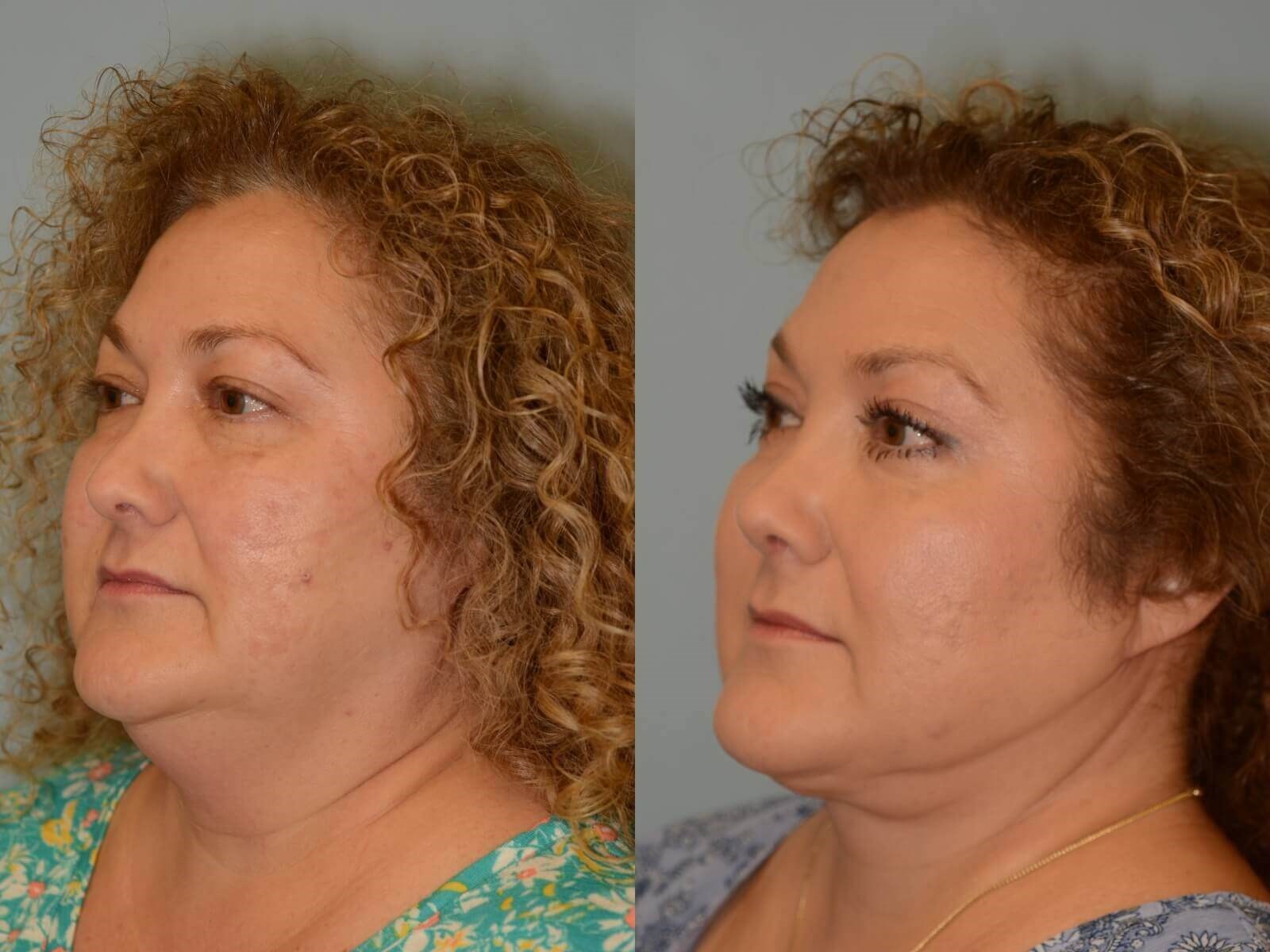 Before and After Neck Lift & Chin Liposuction Photos