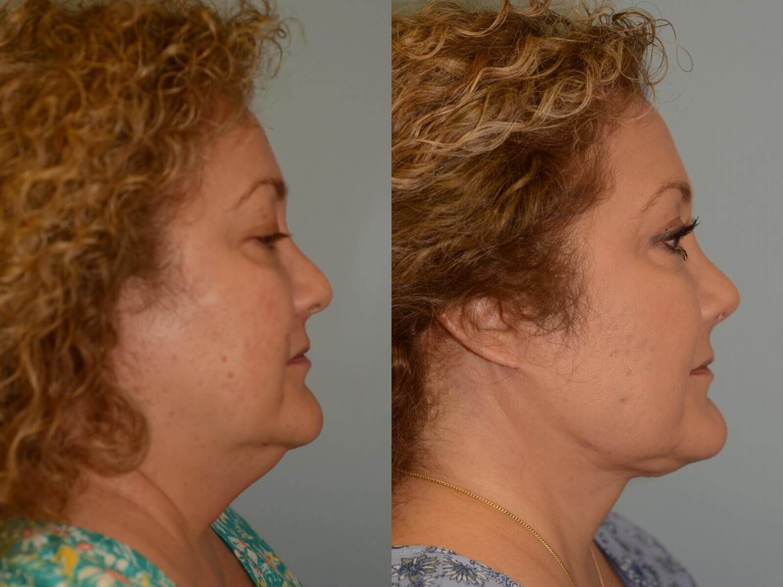 Soft Revision to Nasal Tip Before and After
