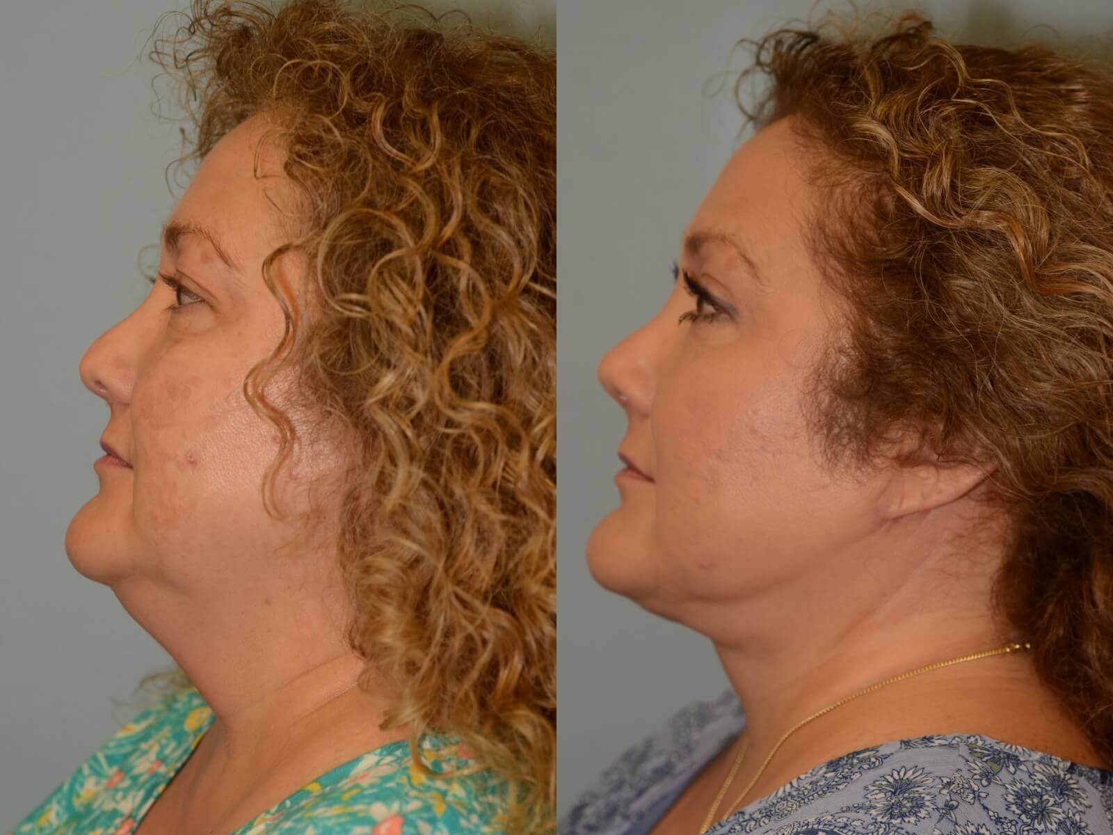 Soft Revision to Nasal Tip Before and After