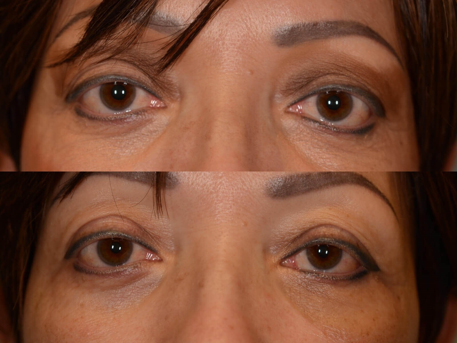 Orbital Decompresion Surgery Before and After
