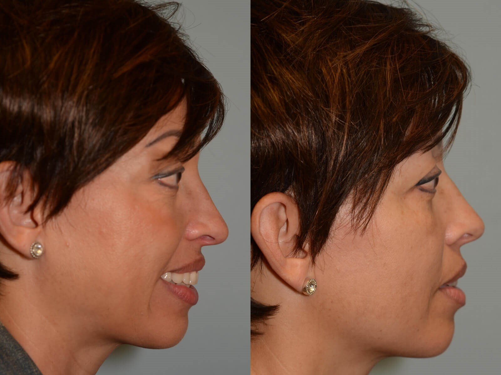 No more bulging eyes Before and After