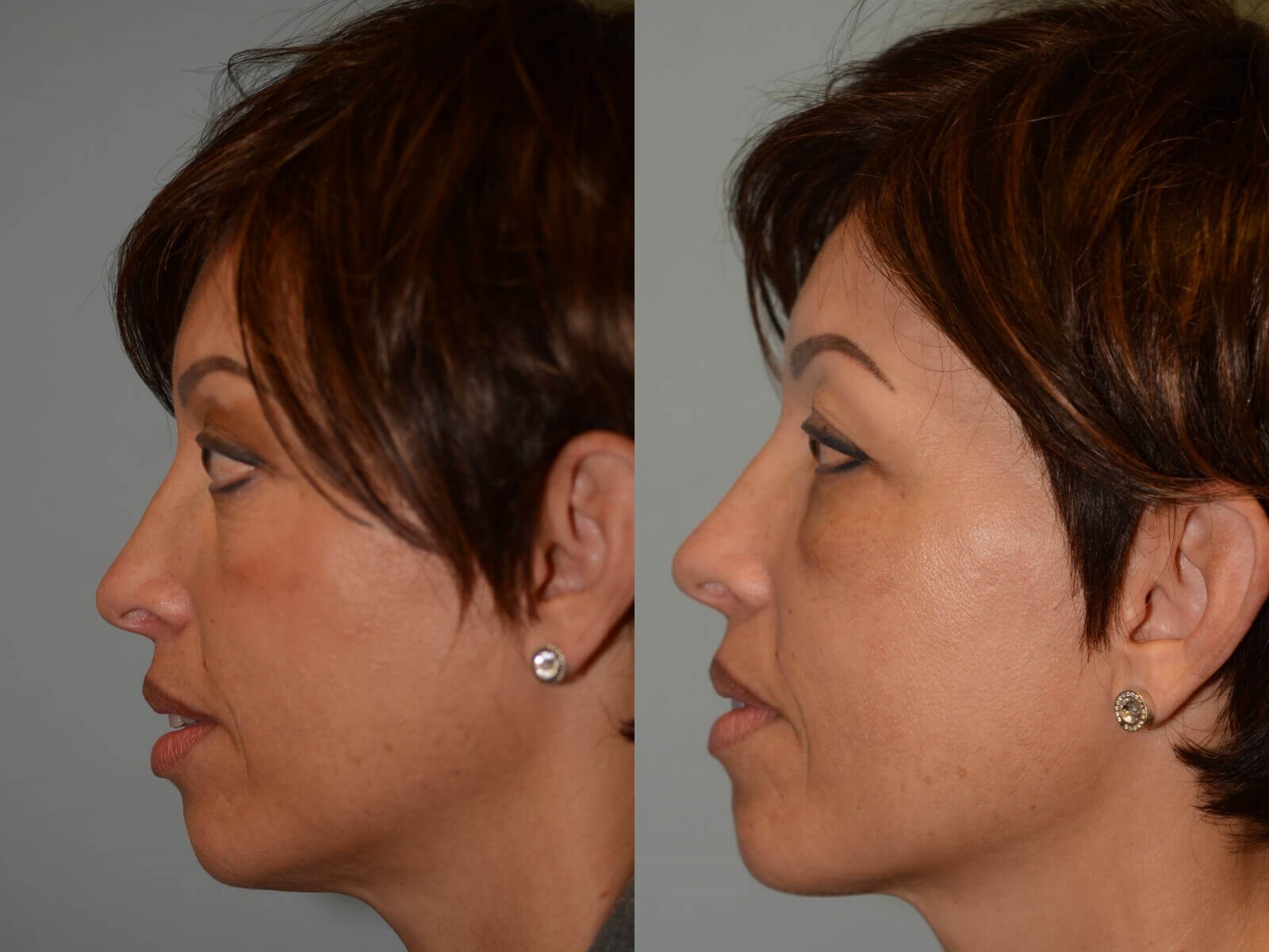 No more bulging eyes Before and After