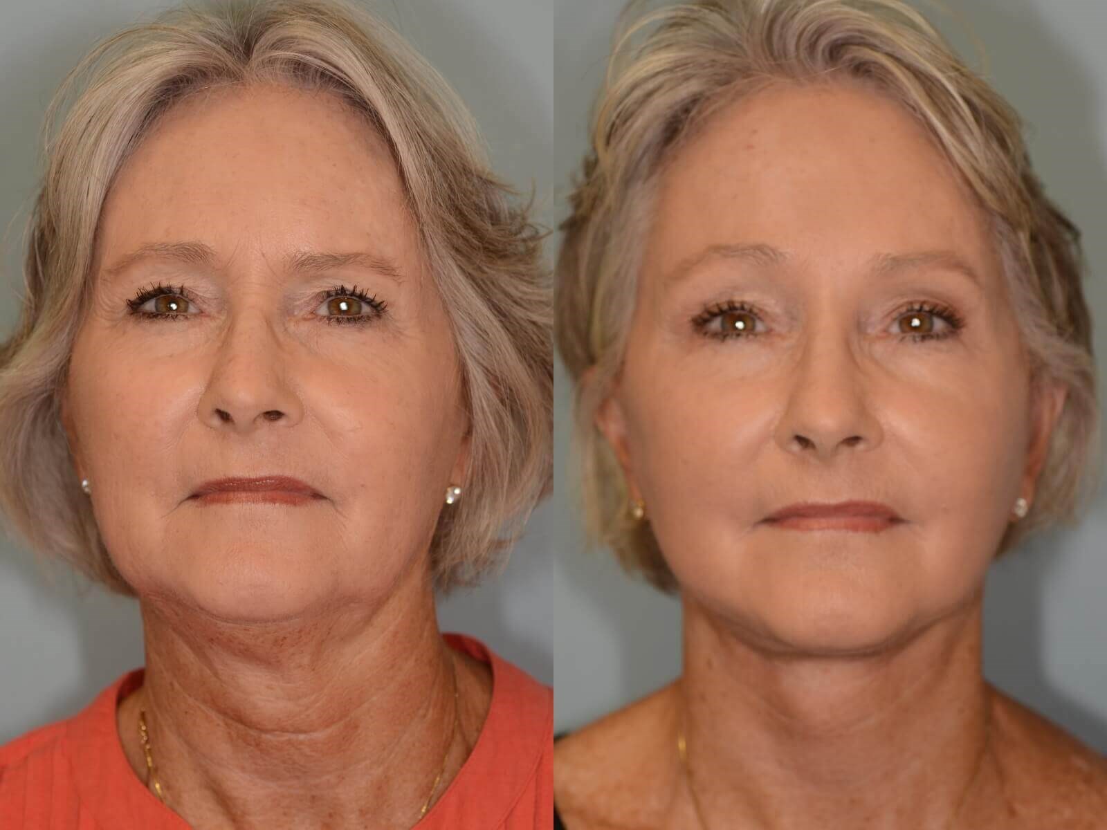 Full Facial Rejuvenation Before and After