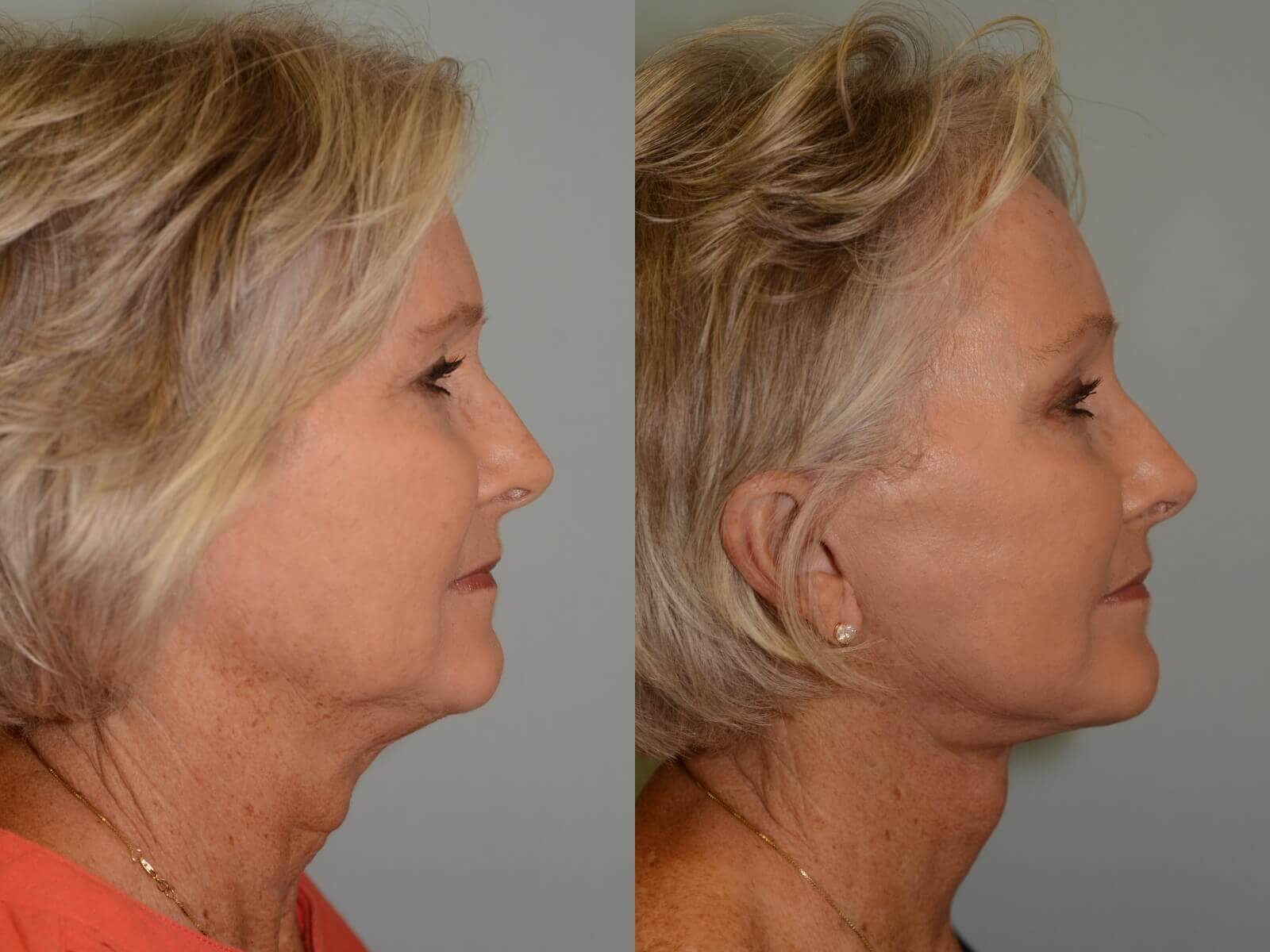 New jaw and neck definition Before and After