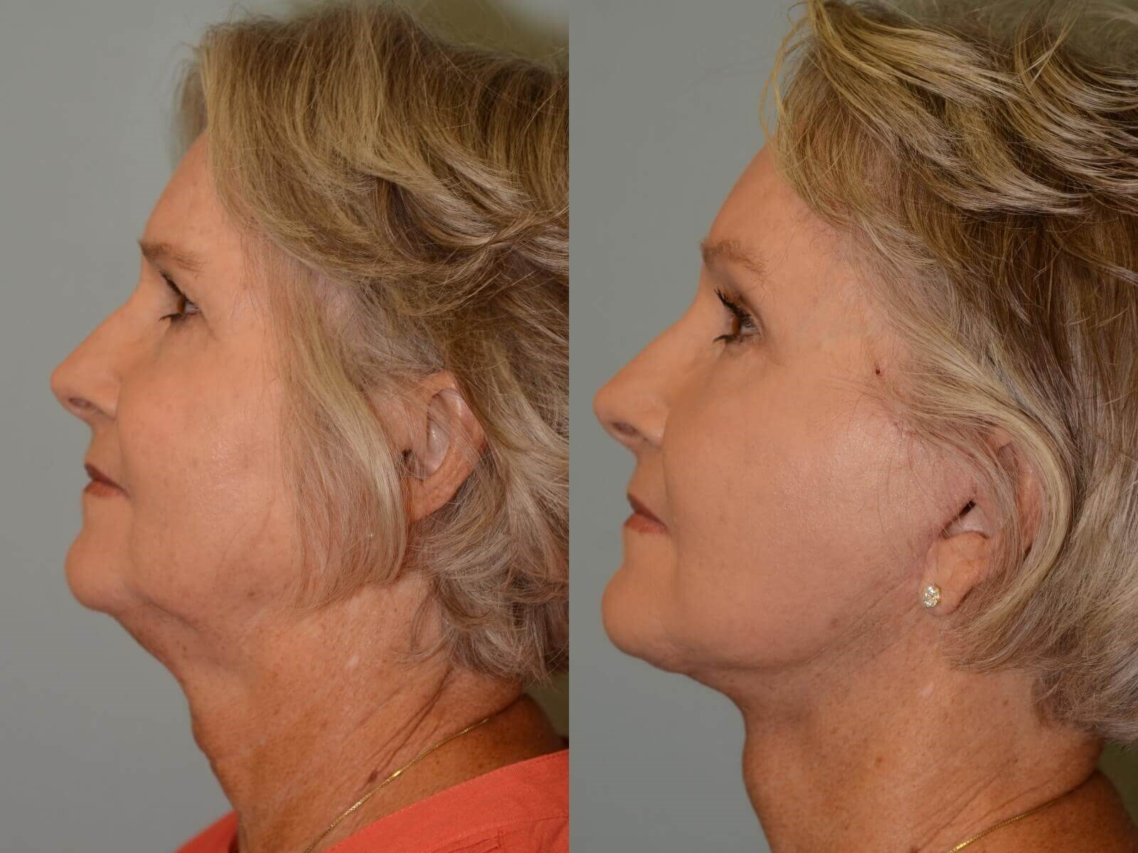 New jaw and neck definition Before and After