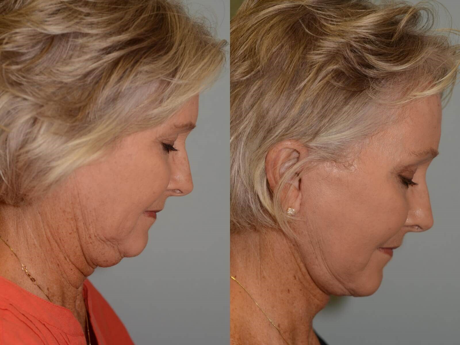 No more double chin! Before and After