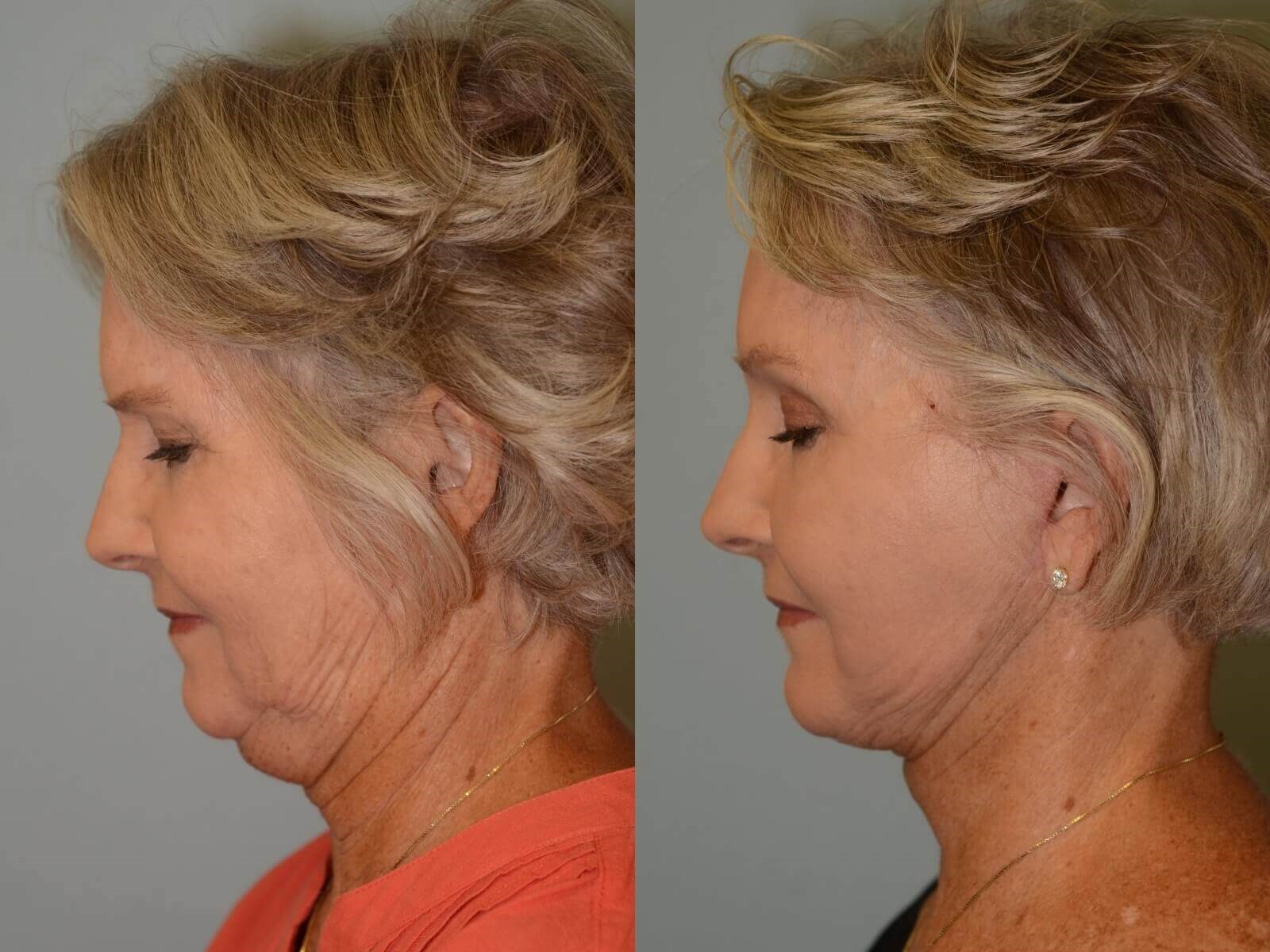 No more double chin! Before and After