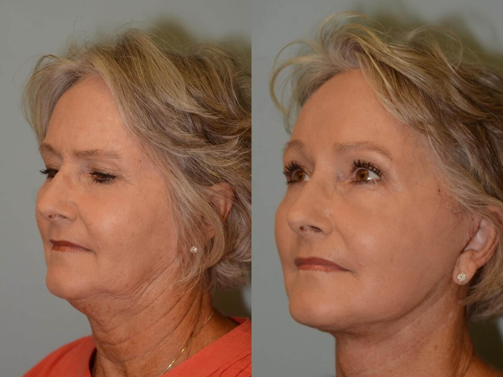 Uplifted and Refreshed Before and After