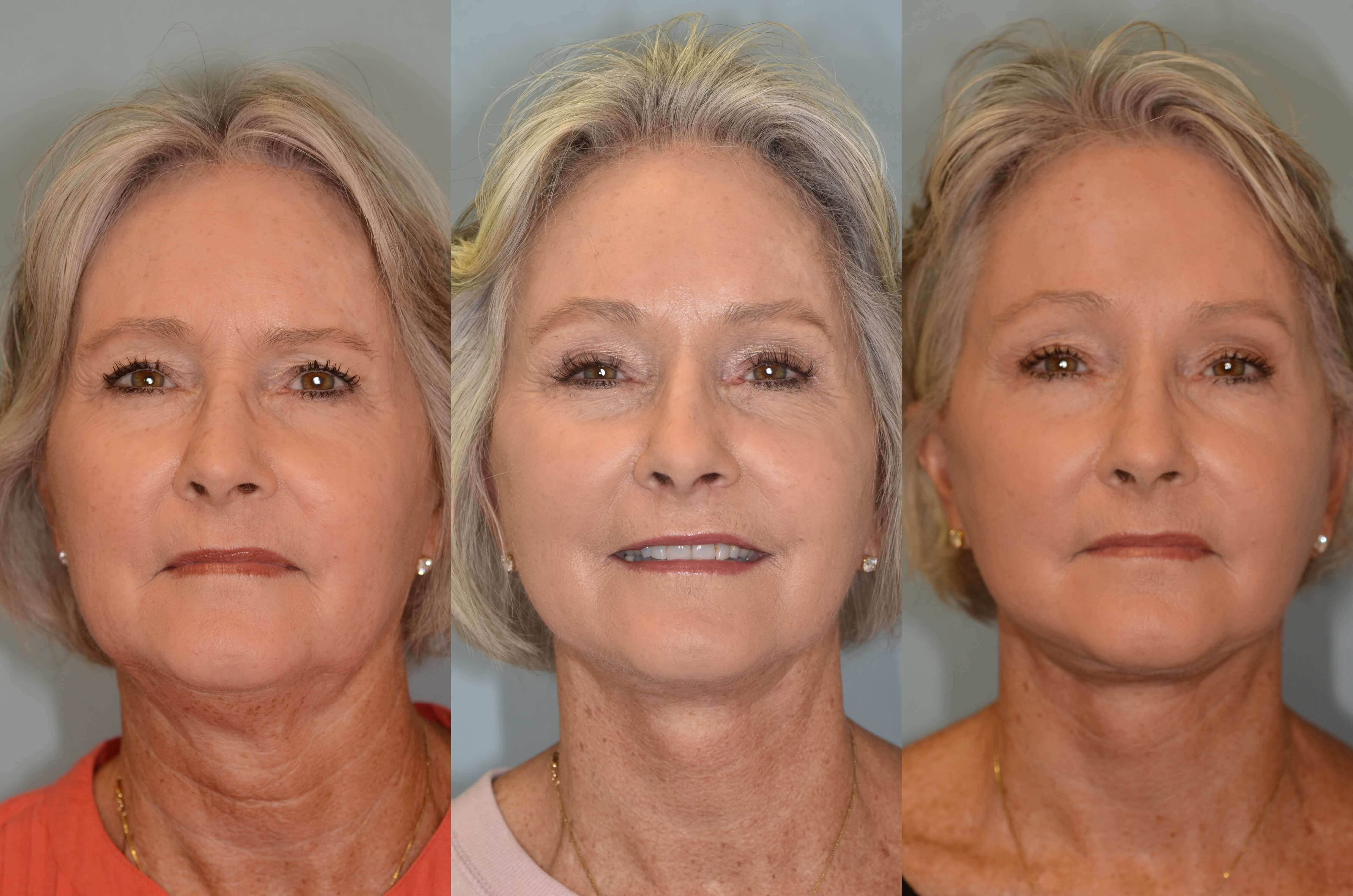 Full Facial Rejuvenation Before and After