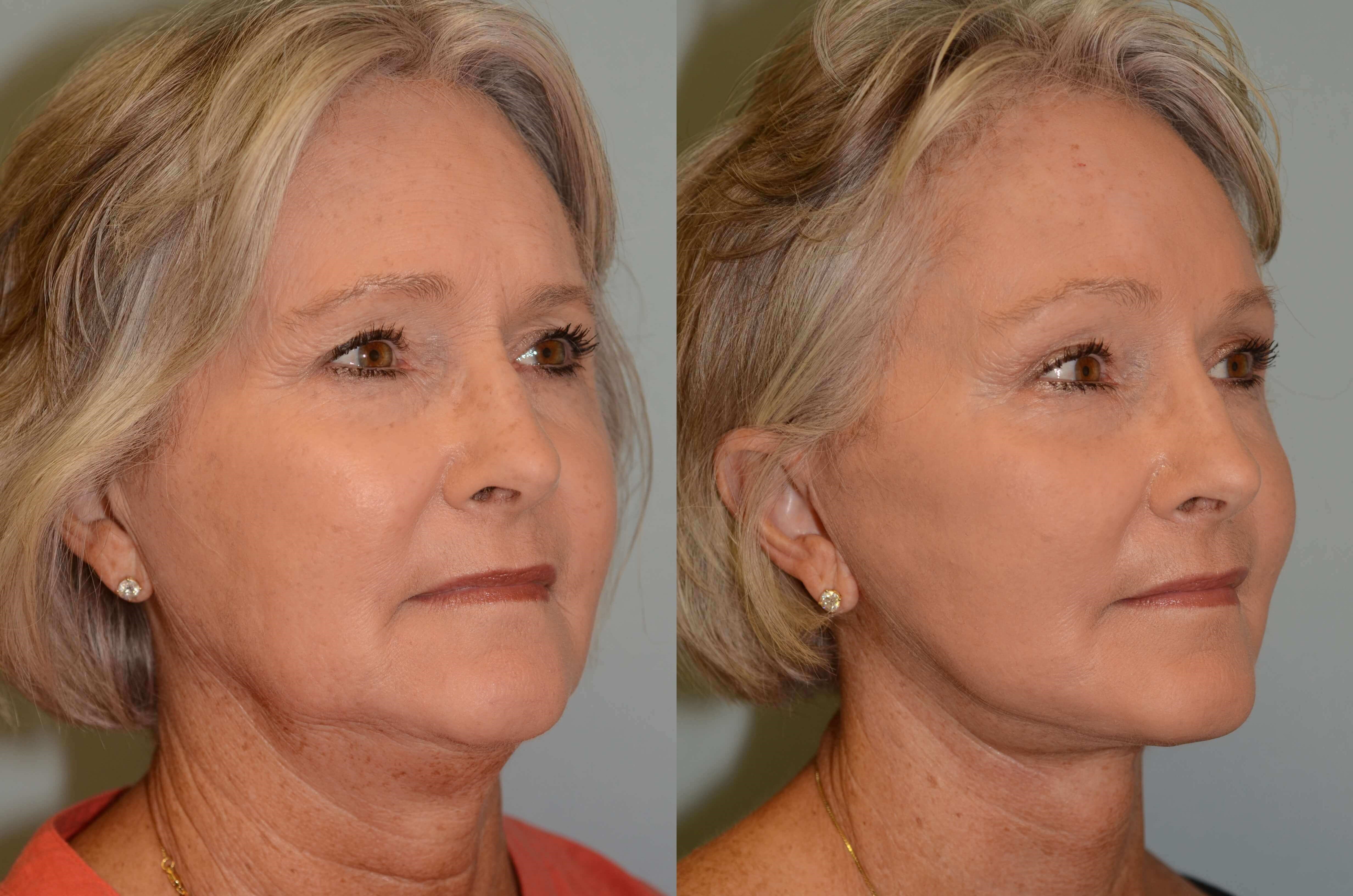 Uplifted and Refreshed Before and After