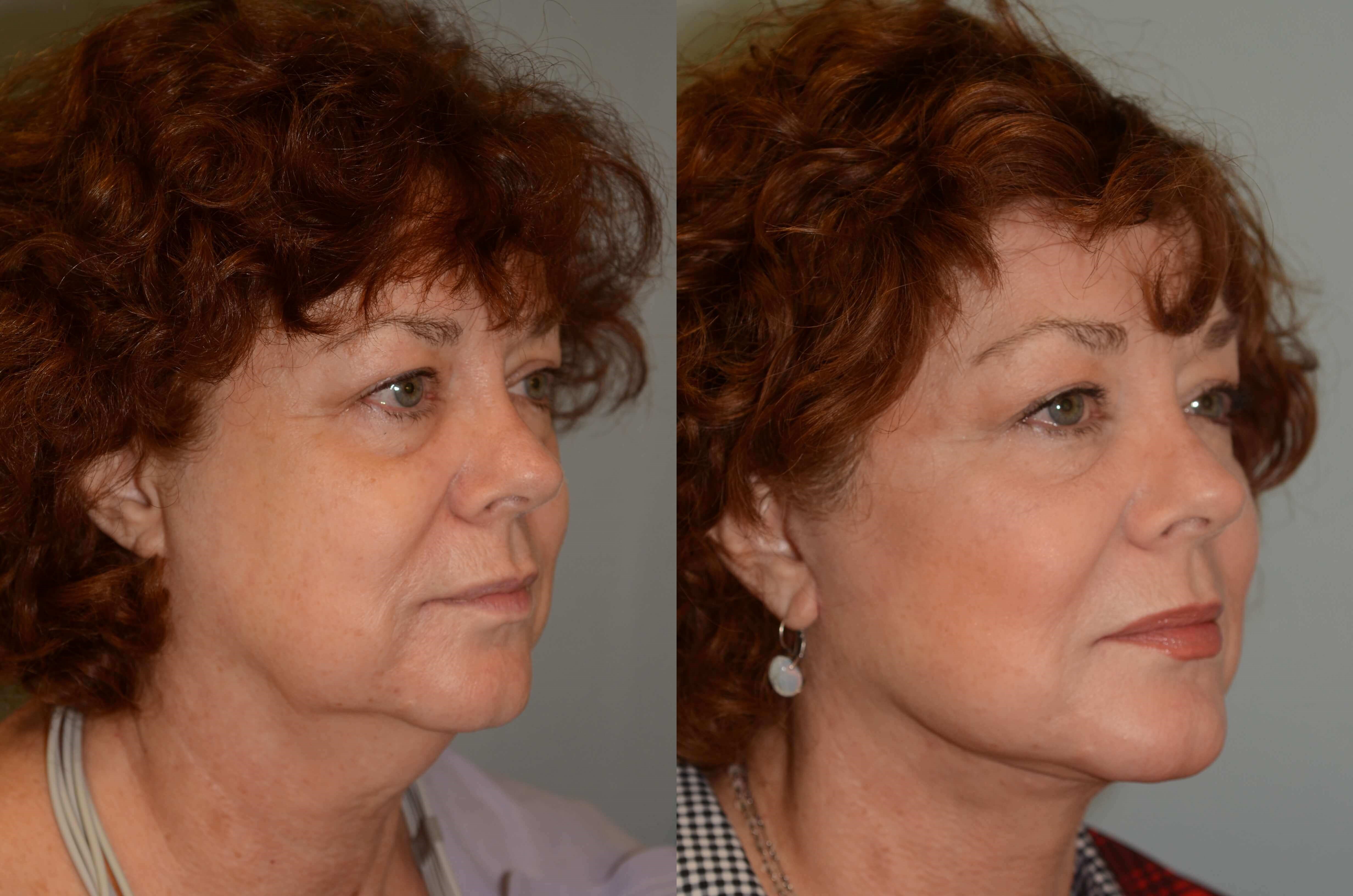 A beautiful jawline Before and After