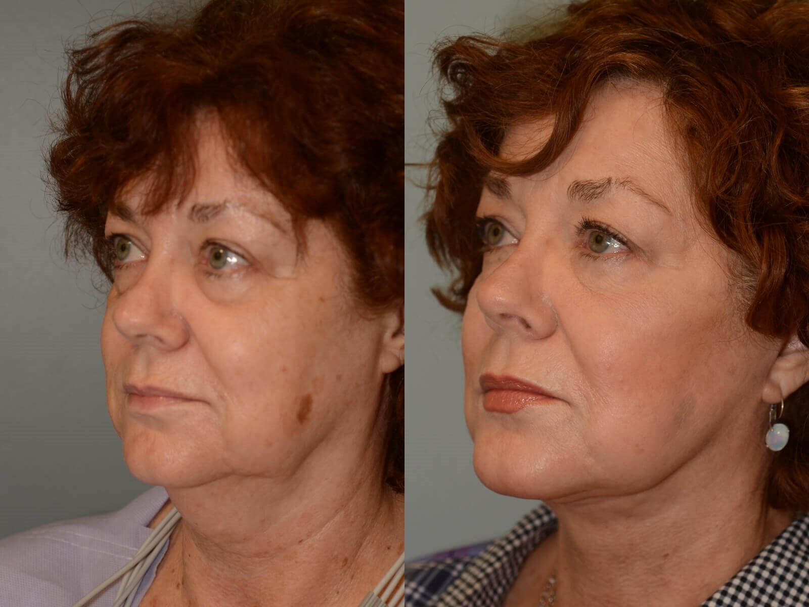 A beautiful jawline Before and After