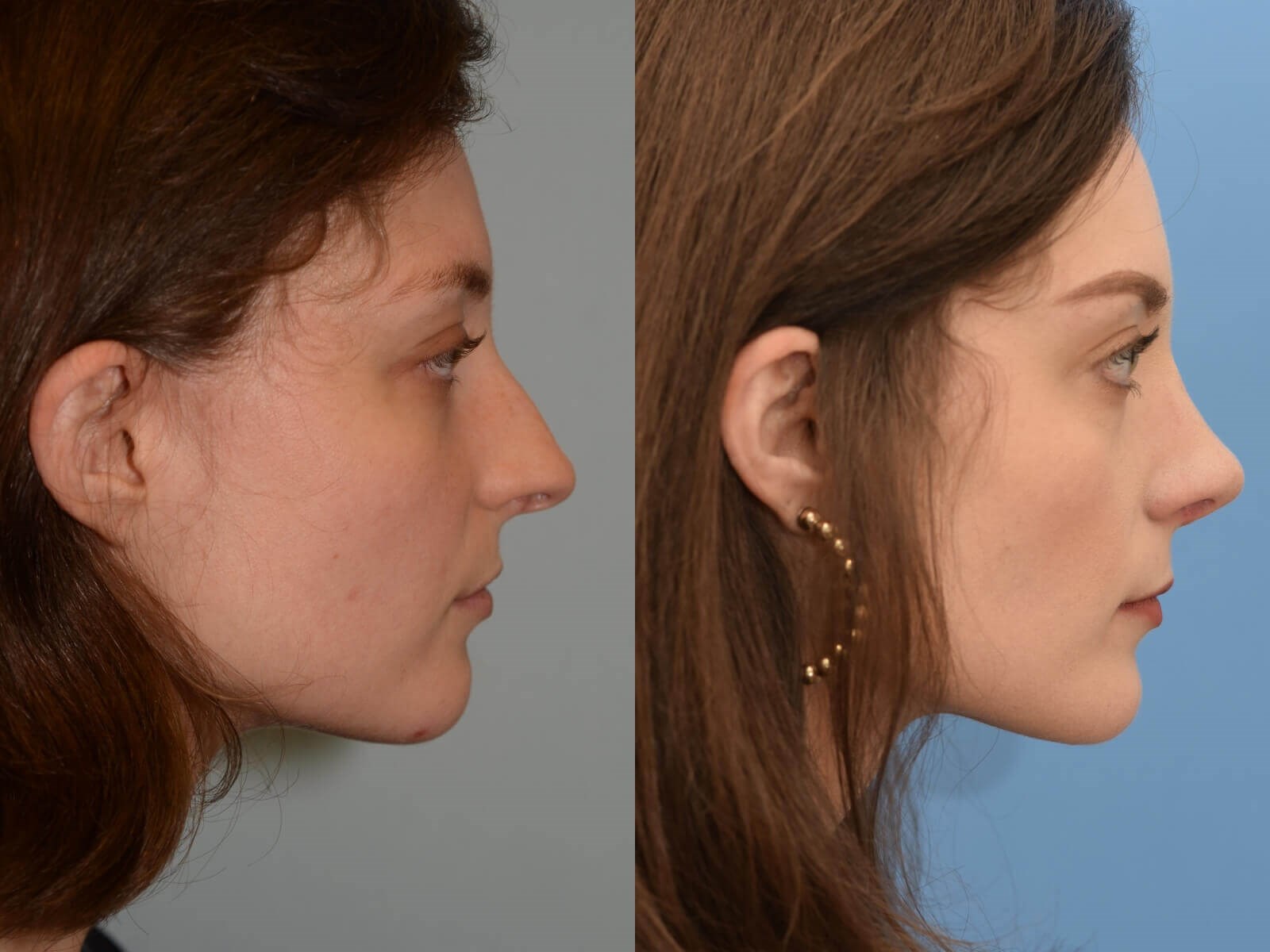 Soft feminine nasal slope Before and After