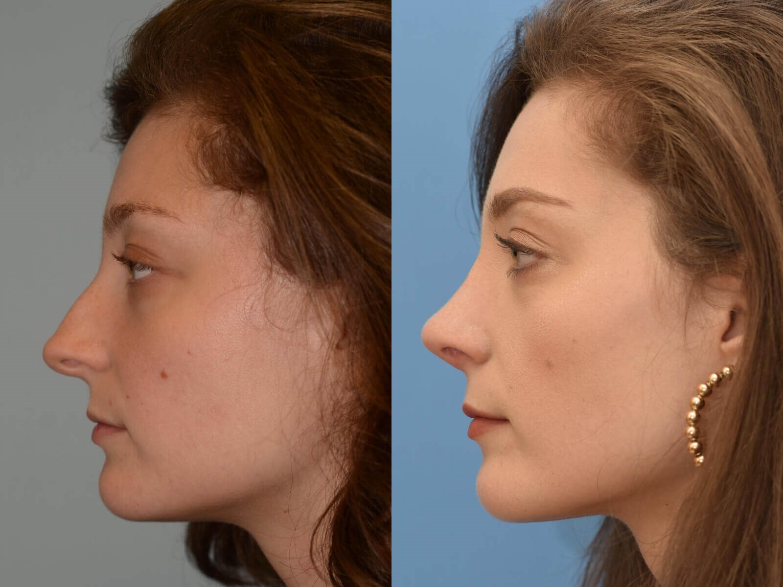Soft feminine nasal slope Before and After