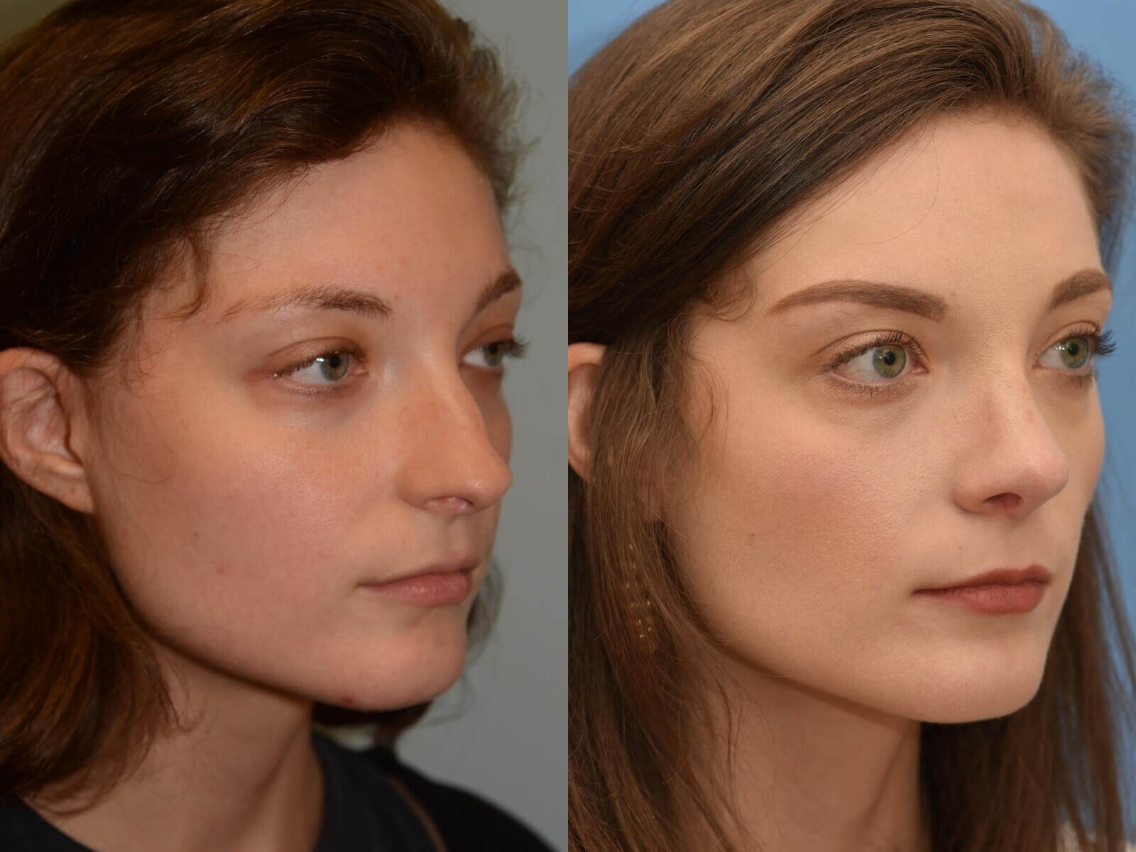 Breathing Beautifully Before and After