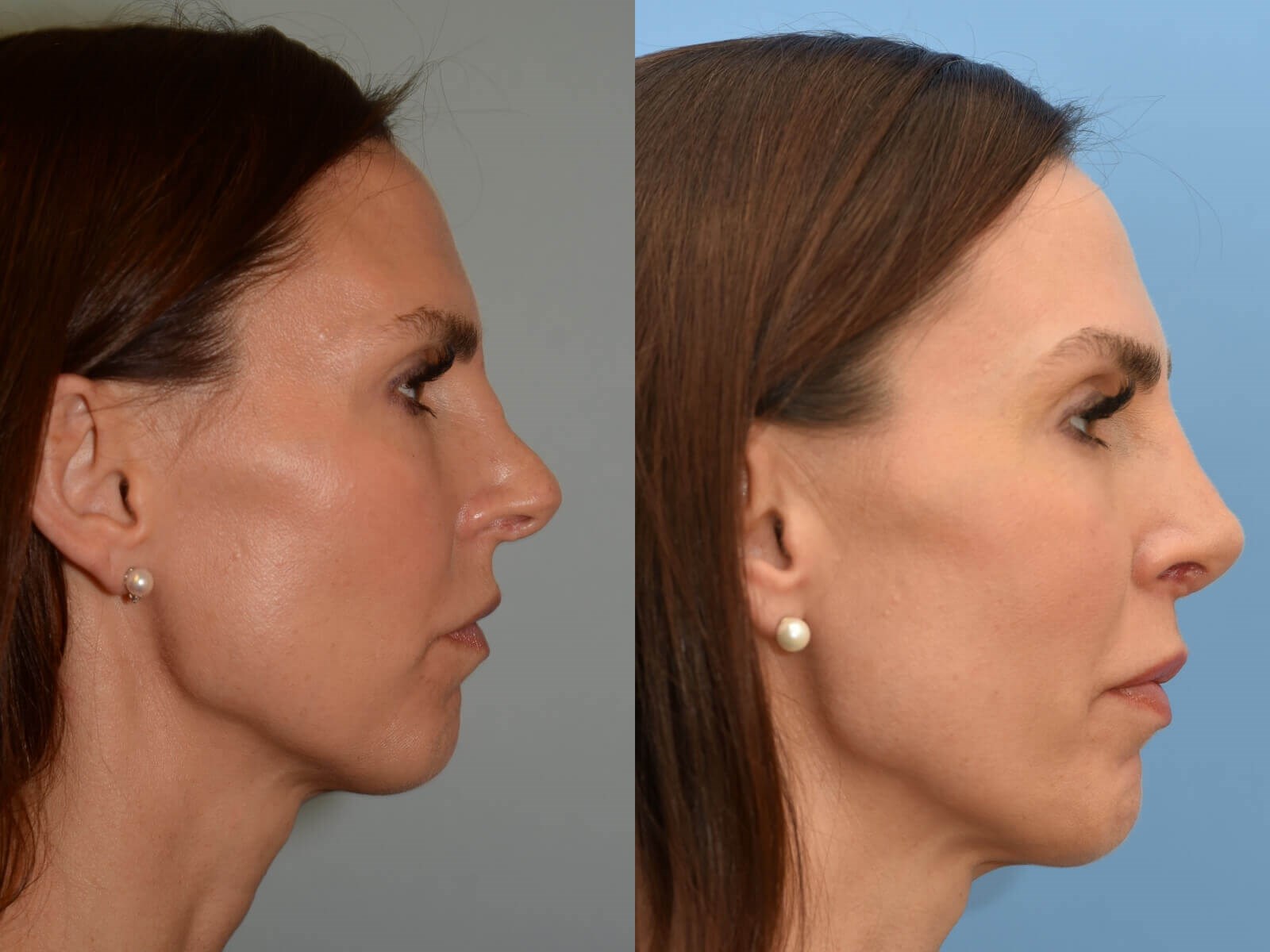 Soft Nasal Slope Before and After