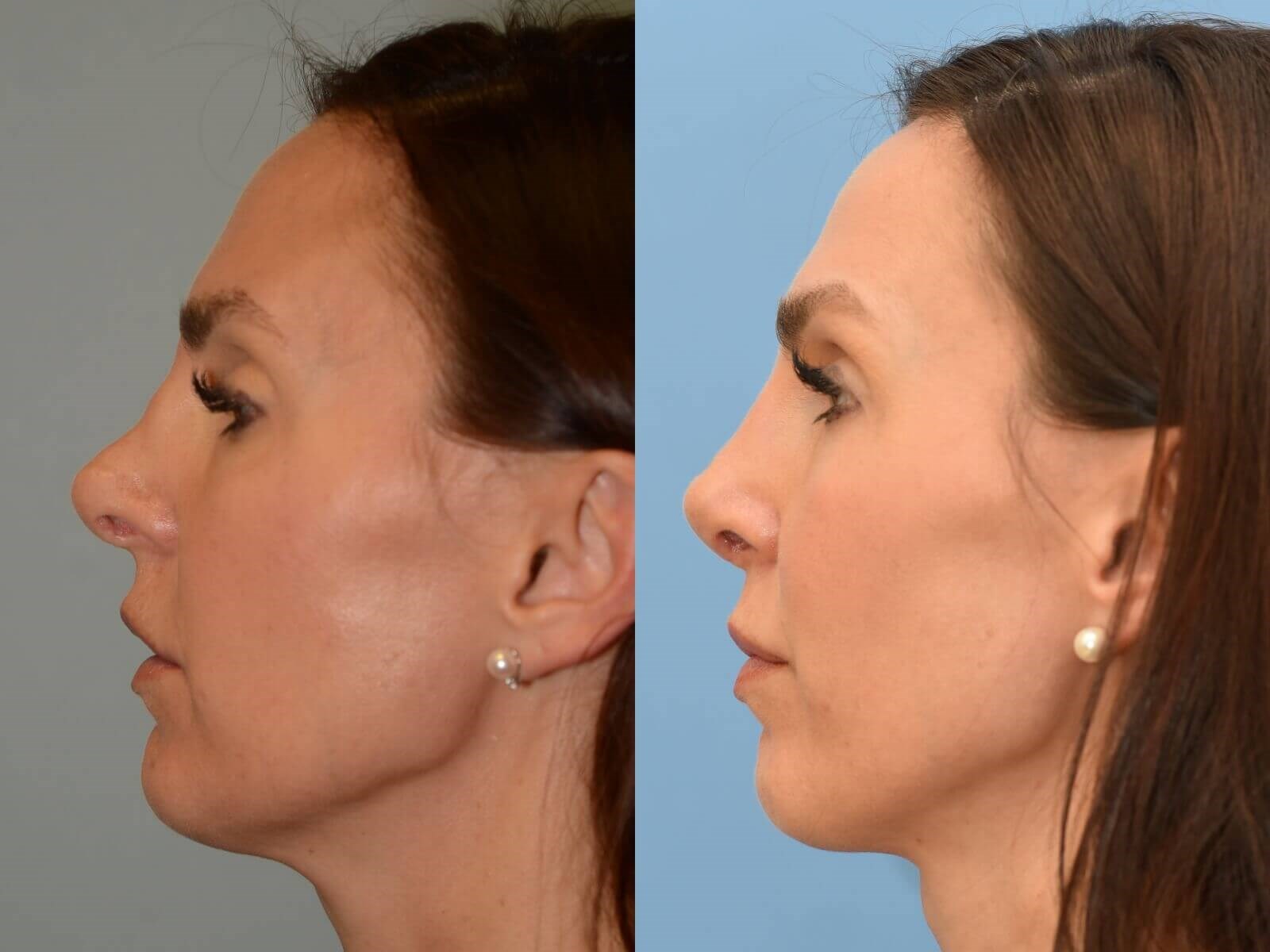Soft Nasal Slope Before and After