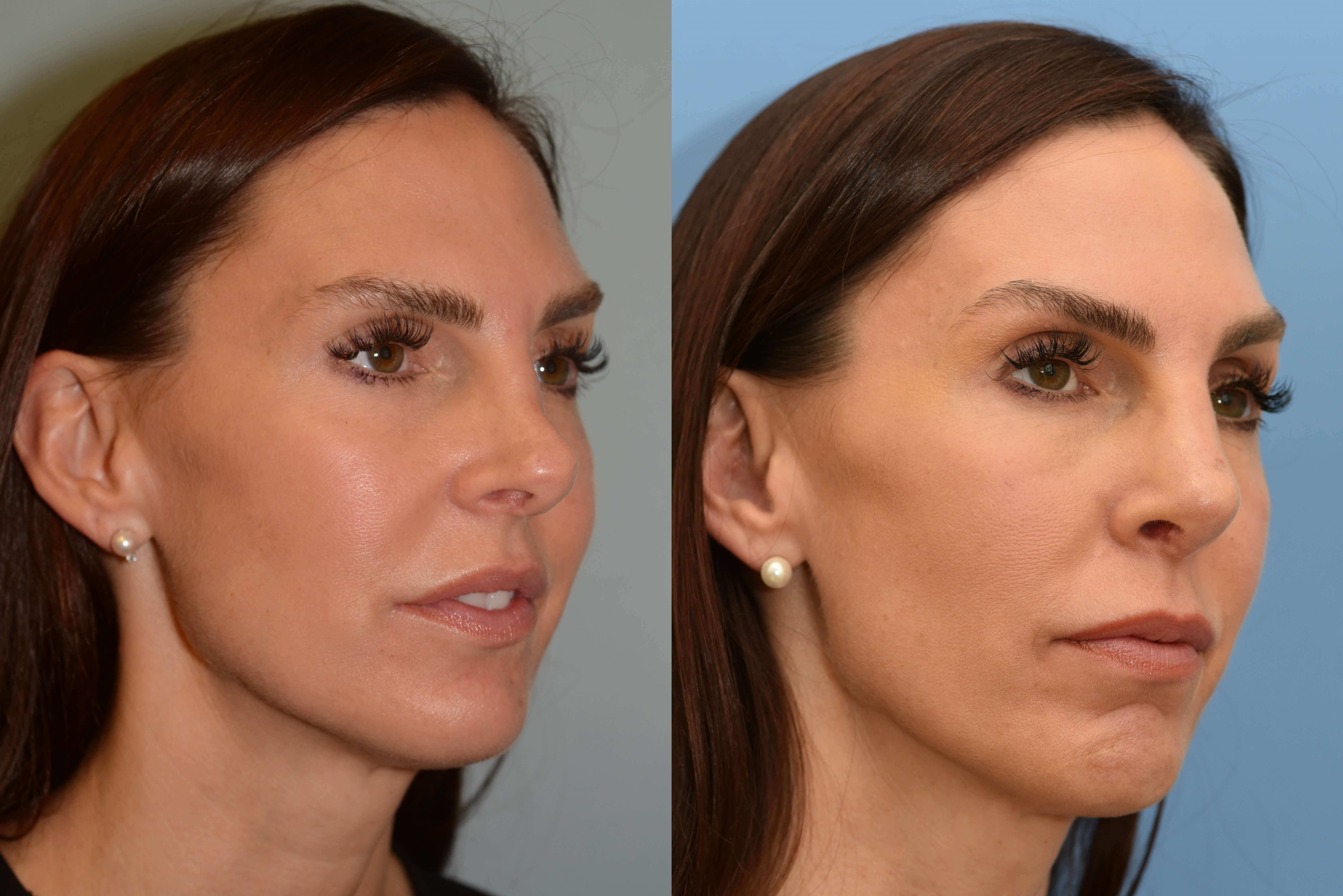 Revision Rhinoplasty Before and After