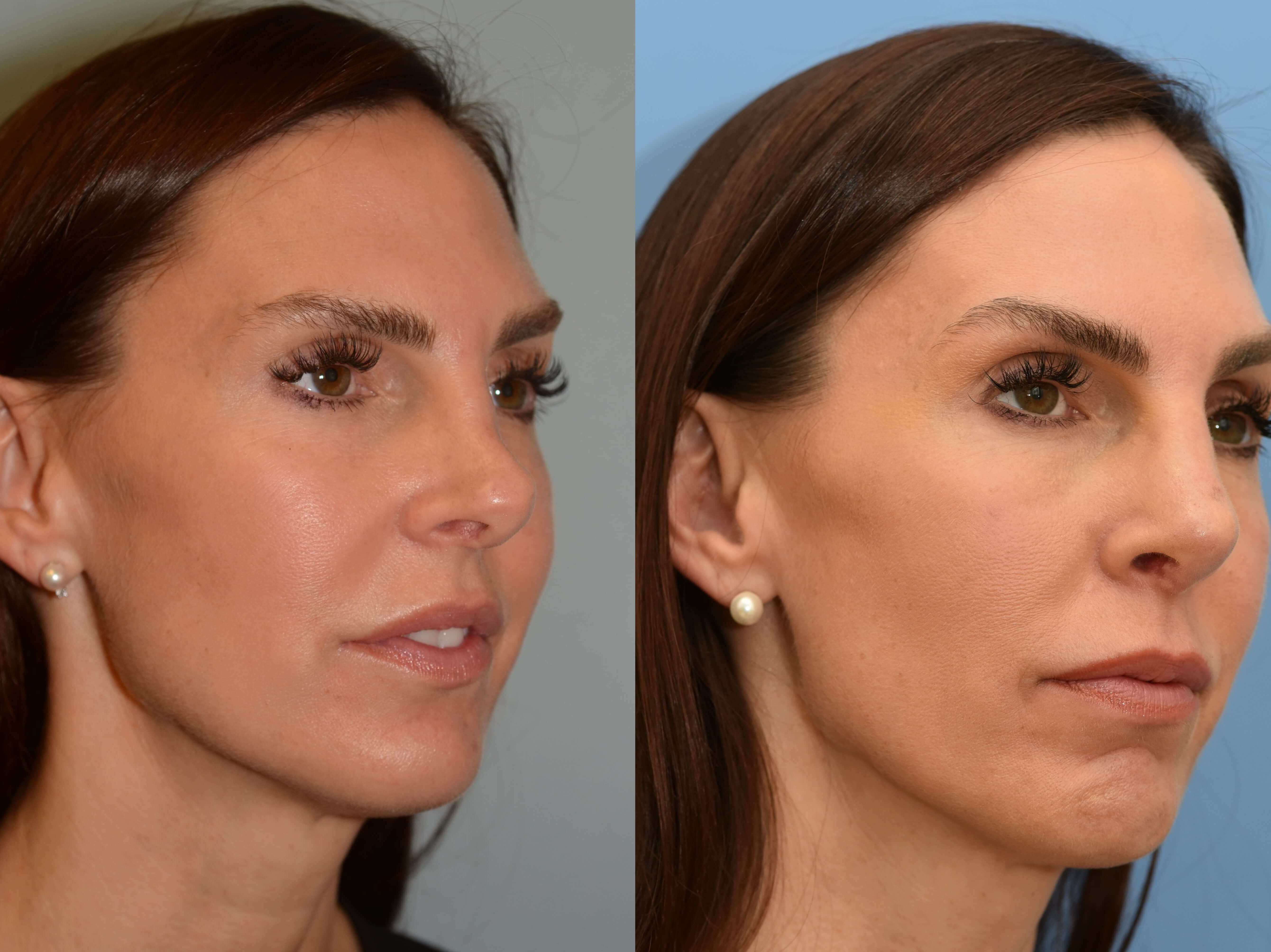 Revision Rhinoplasty Before and After