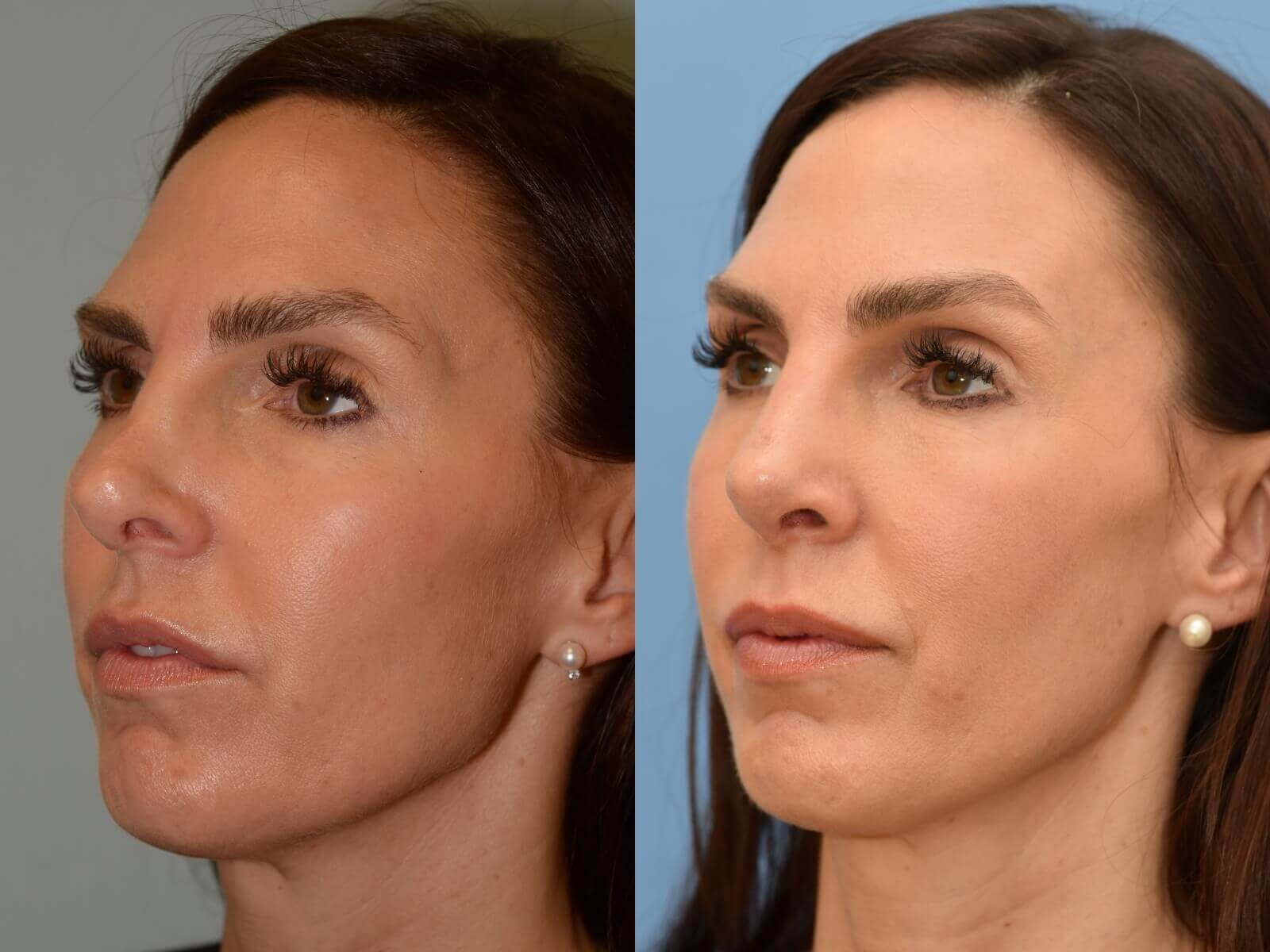 Revision Rhinoplasty Before and After