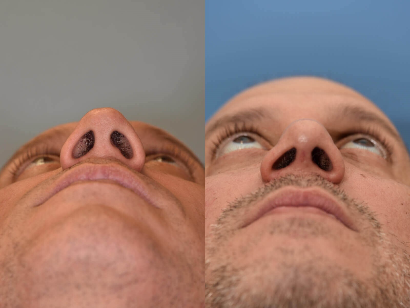Nasal Valve Collapse Repair Before and After