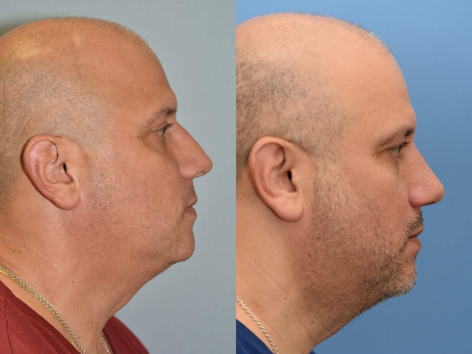 Notice the improved profile Before and After