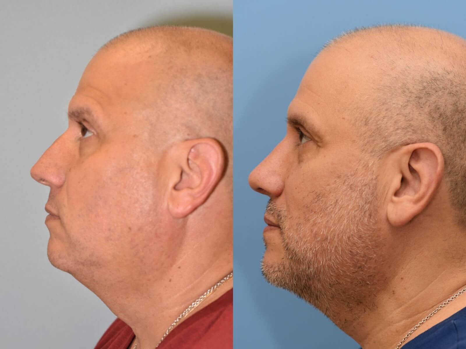 Notice the improved profile Before and After