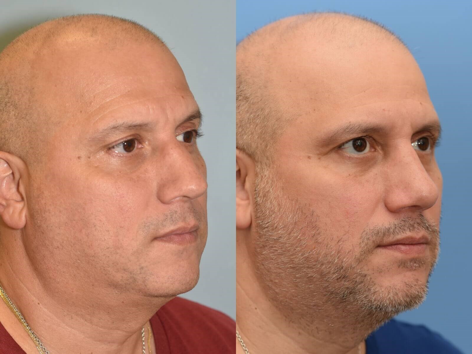 No more collapse! Before and After