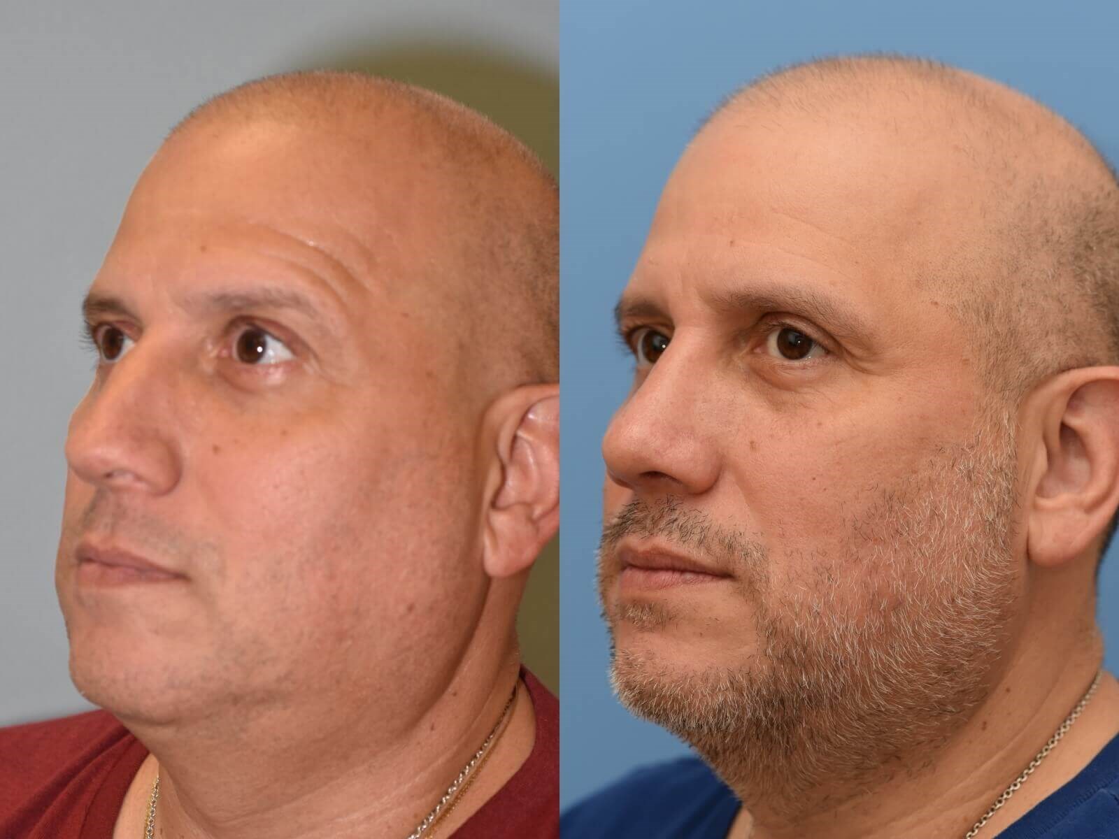 No more collapse! Before and After