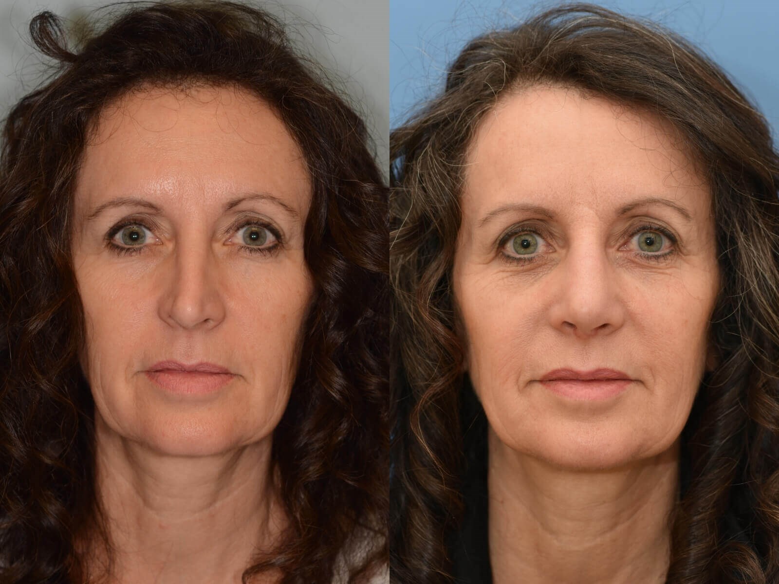 Nasal Obstruction Repaired Before and After