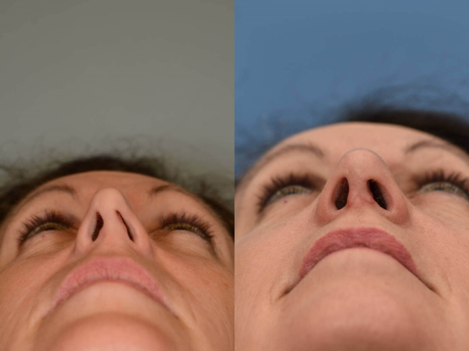 Nasal Obstruction Repaired Before and After