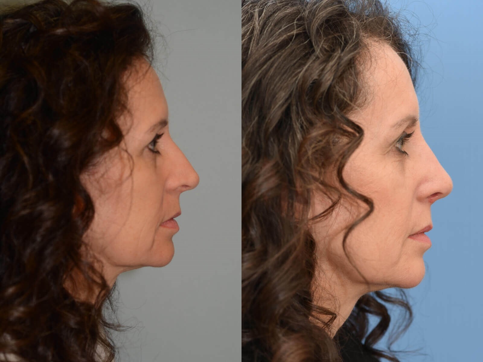 Beautiful Nasal Slope Before and After