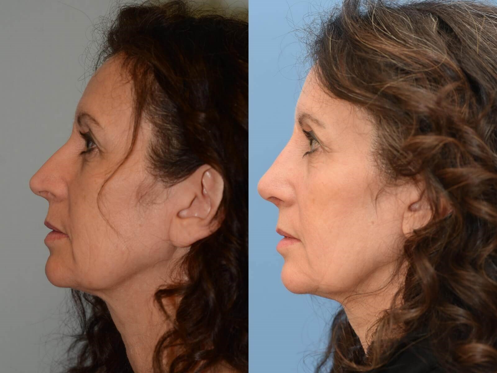 Beautiful Nasal Slope Before and After
