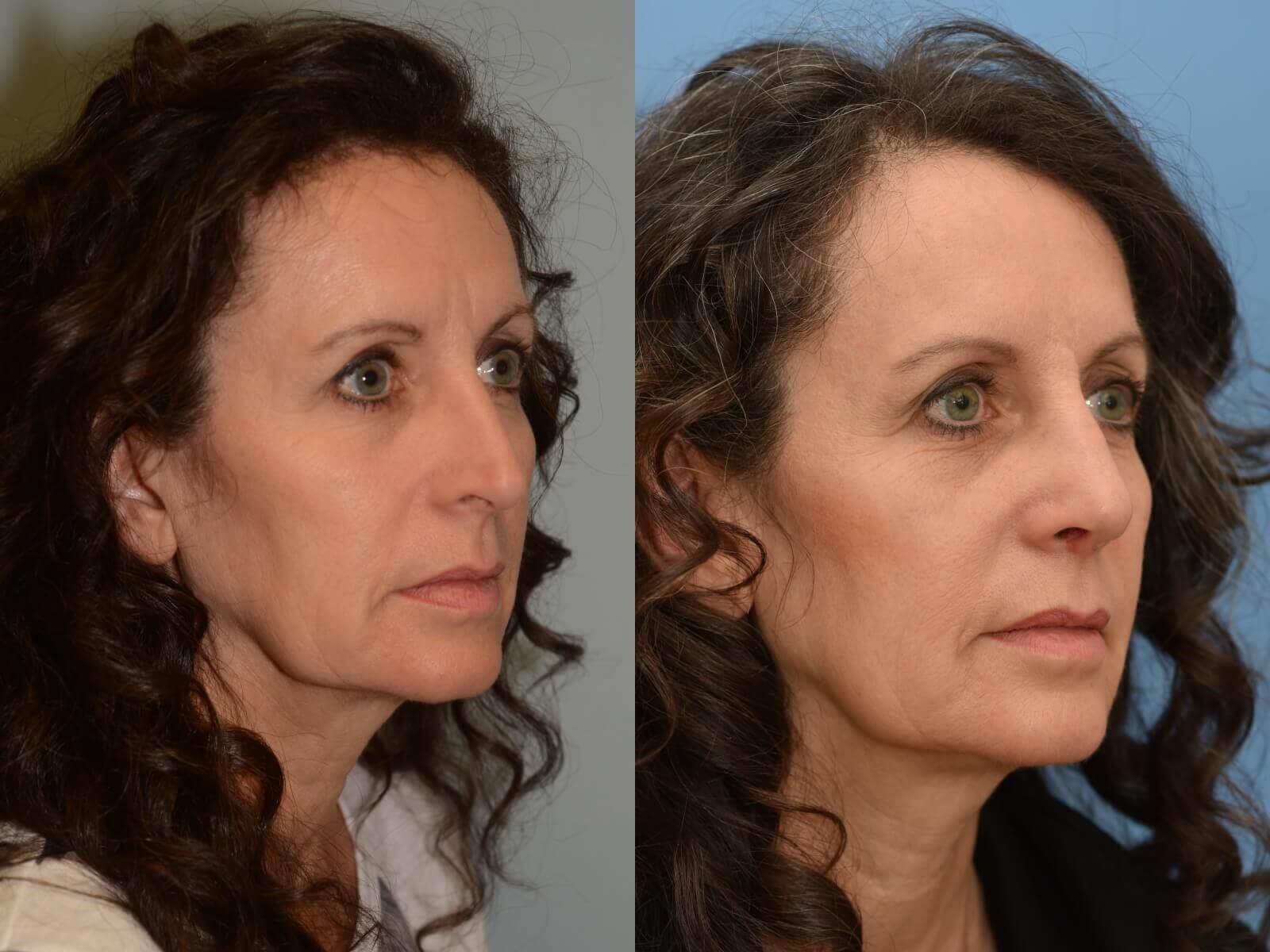 A more balanced nose! Before and After