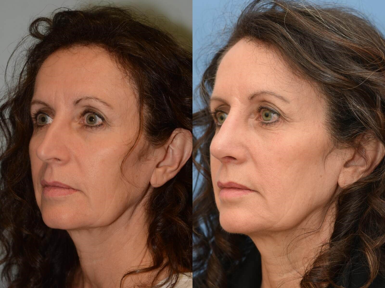 A more balanced nose! Before and After