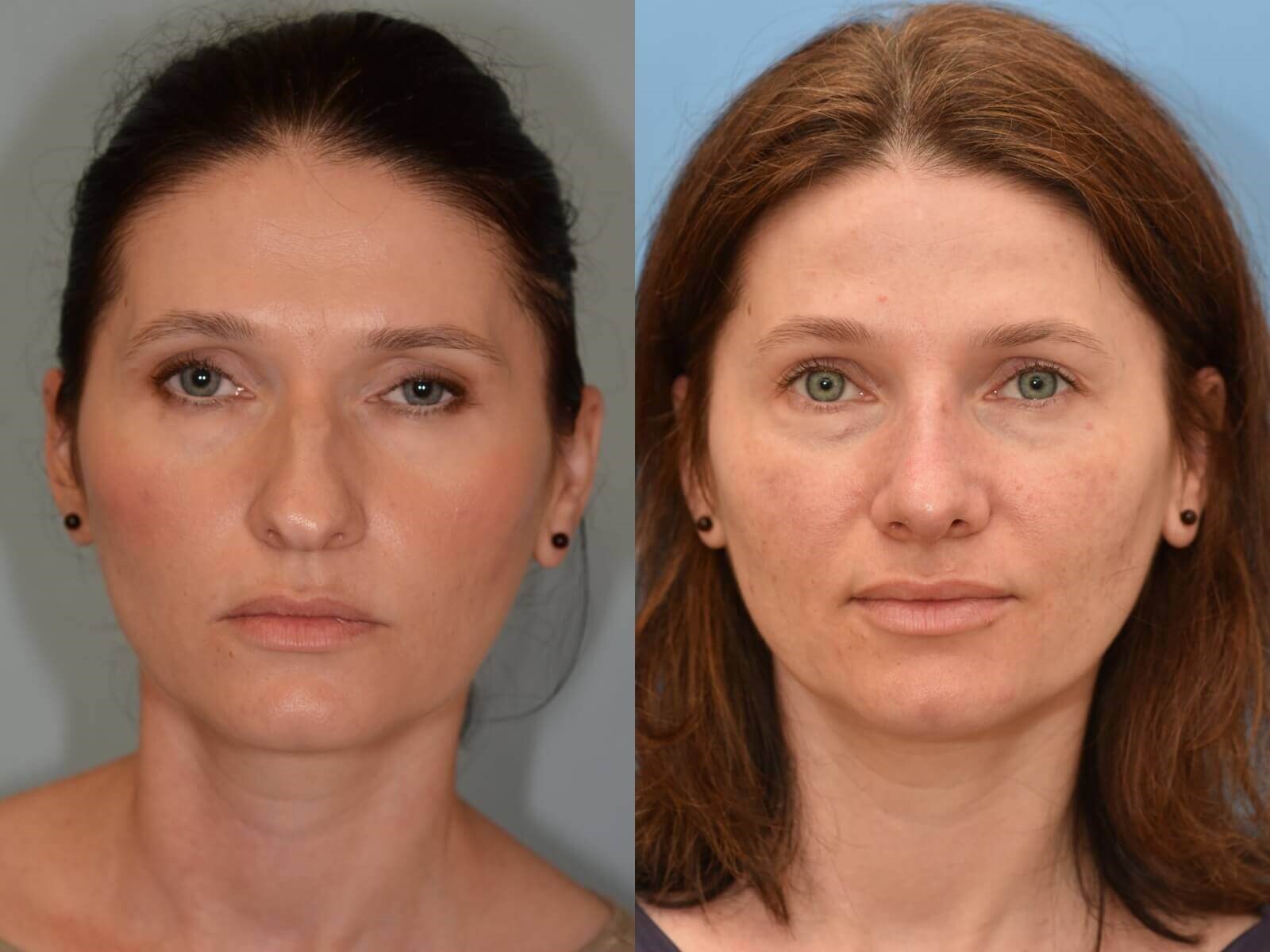 Rhinoplasty Before and After