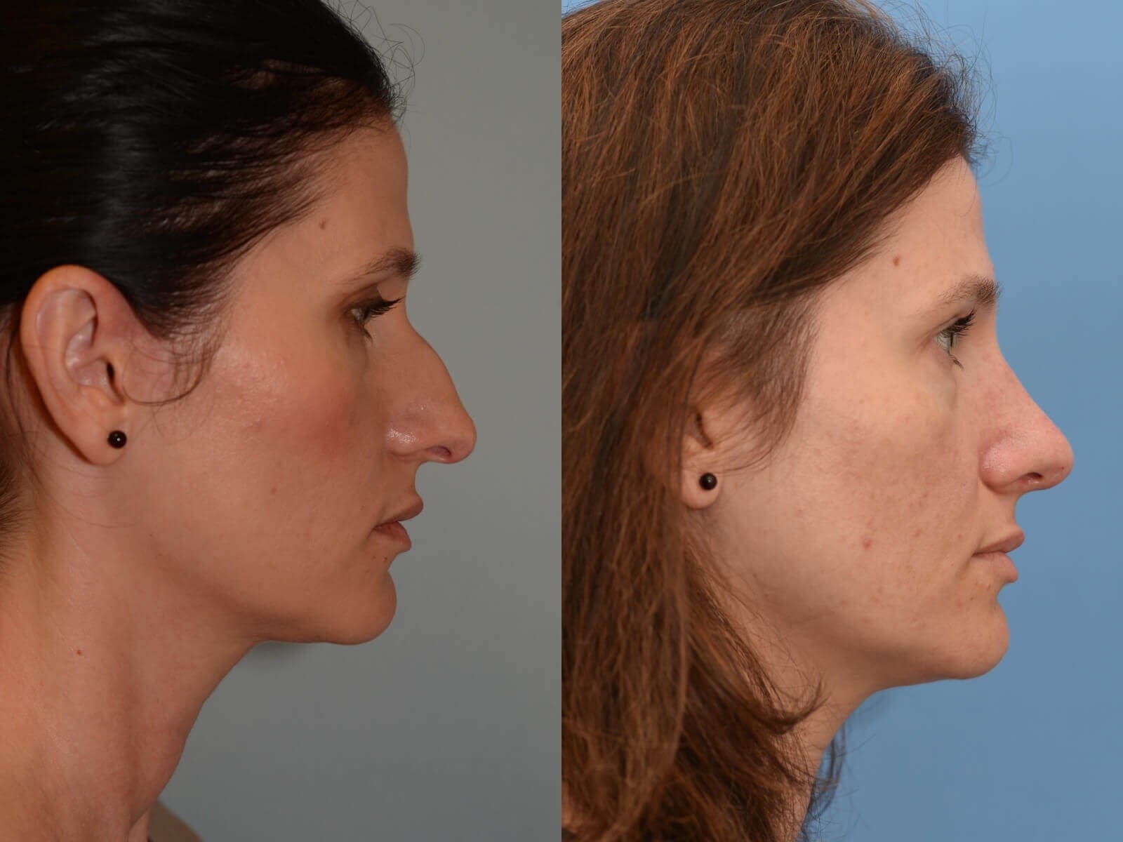 Dramatically Improved Profile! Before and After