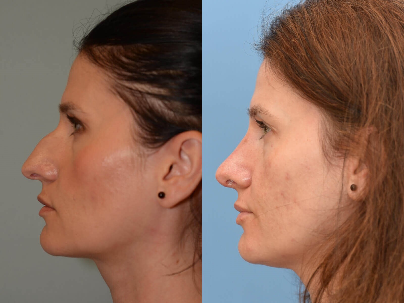 Dramatically Improved Profile! Before and After