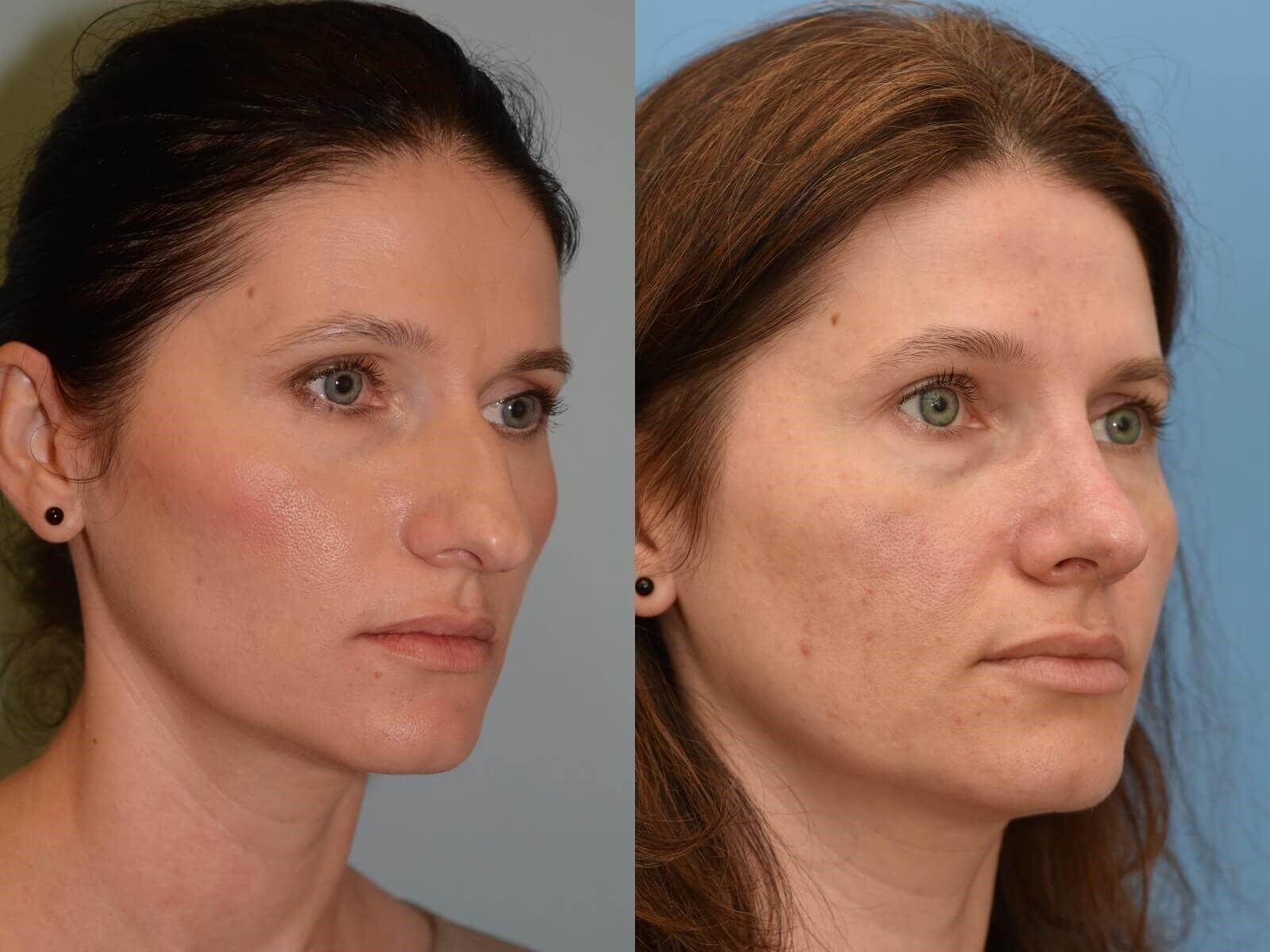 A Soft and Feminine Nose Before and After