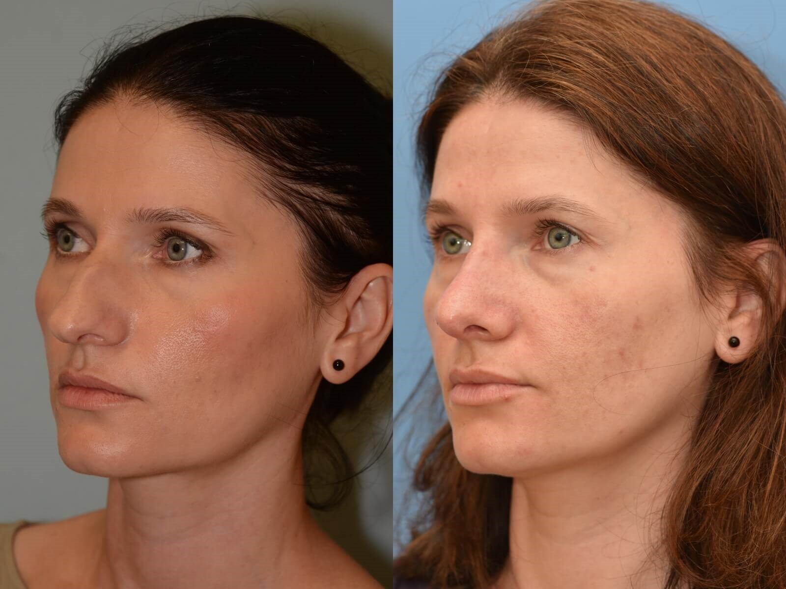A Soft and Feminine Nose Before and After