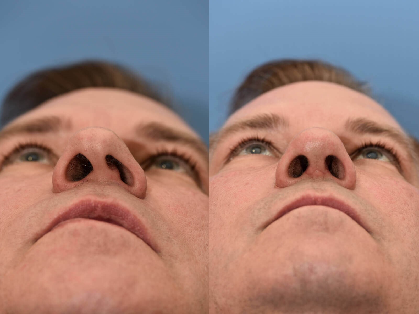 Nasal Valve and Septum Repair Before and After