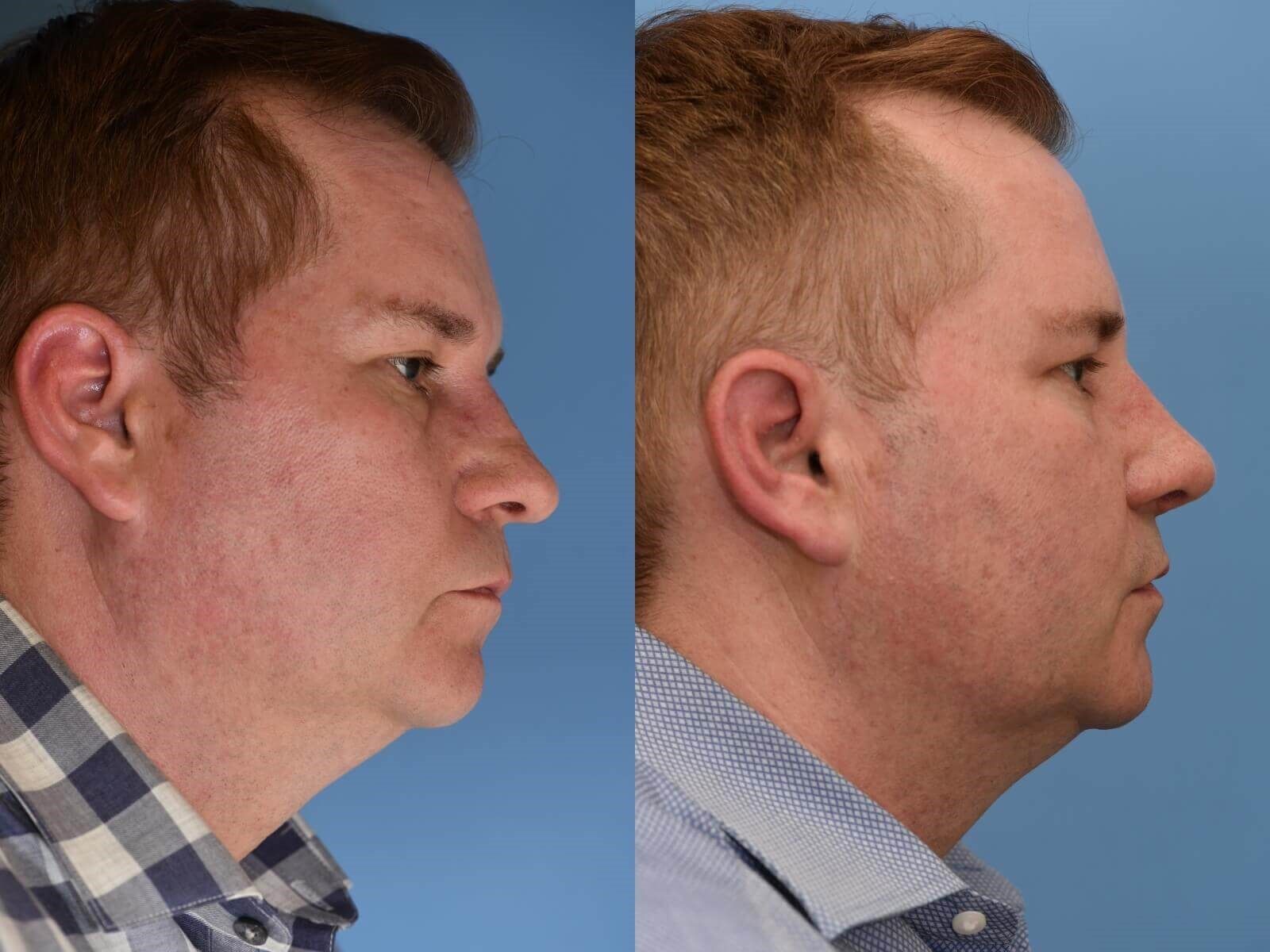 Nasal Valve Collapse repaired Before and After