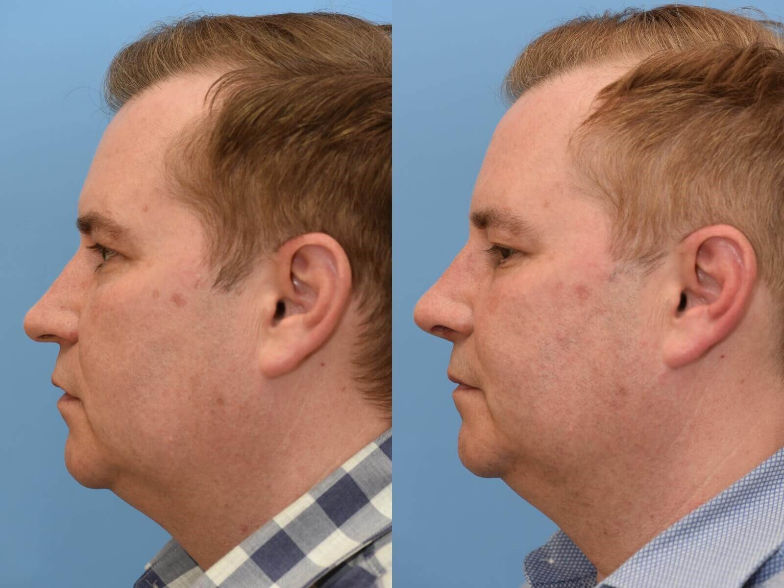Nasal Valve Collapse repaired Before and After