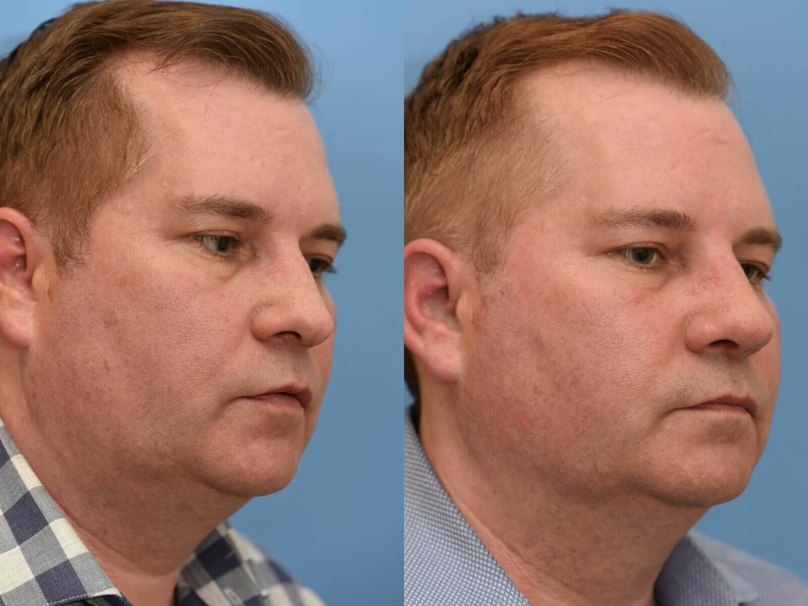 Restored Breathing! Before and After